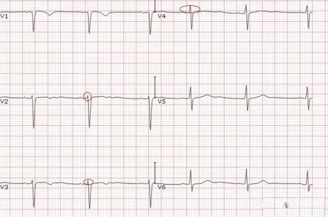 顺钟向转位心电图图片