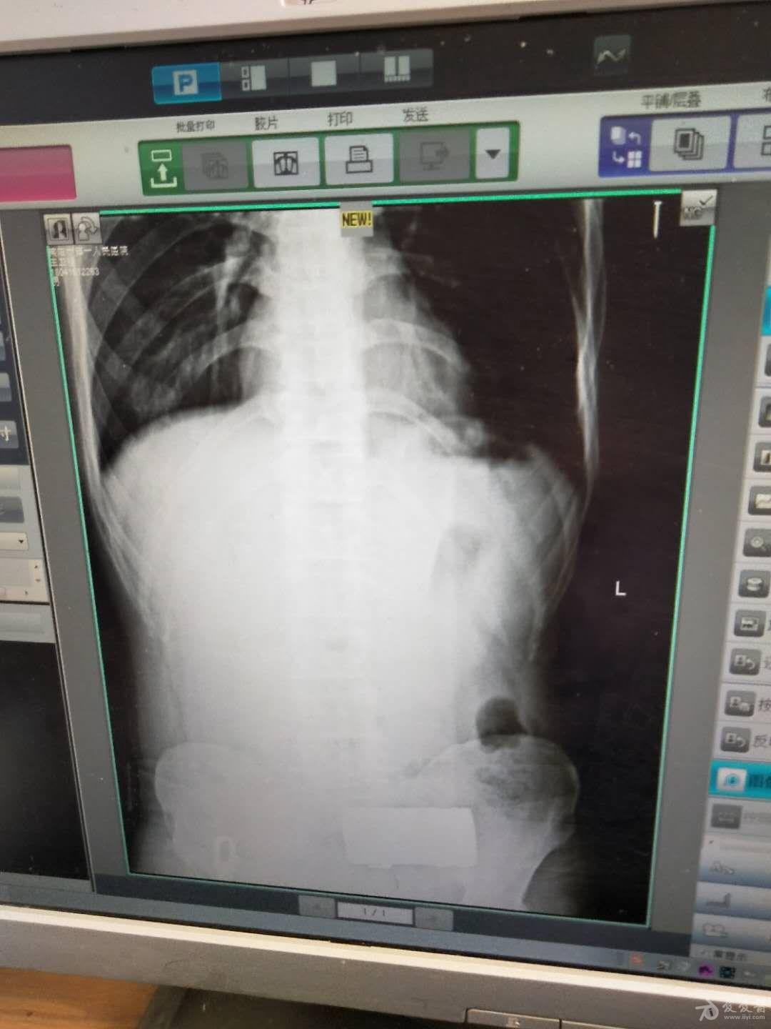 超声入门贴776急腹症之小肠梗阻