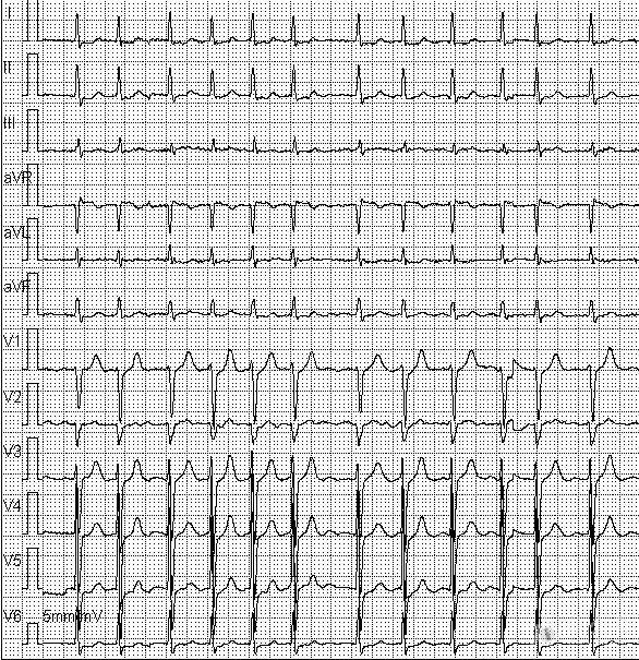 房颤心电图 室上速图片