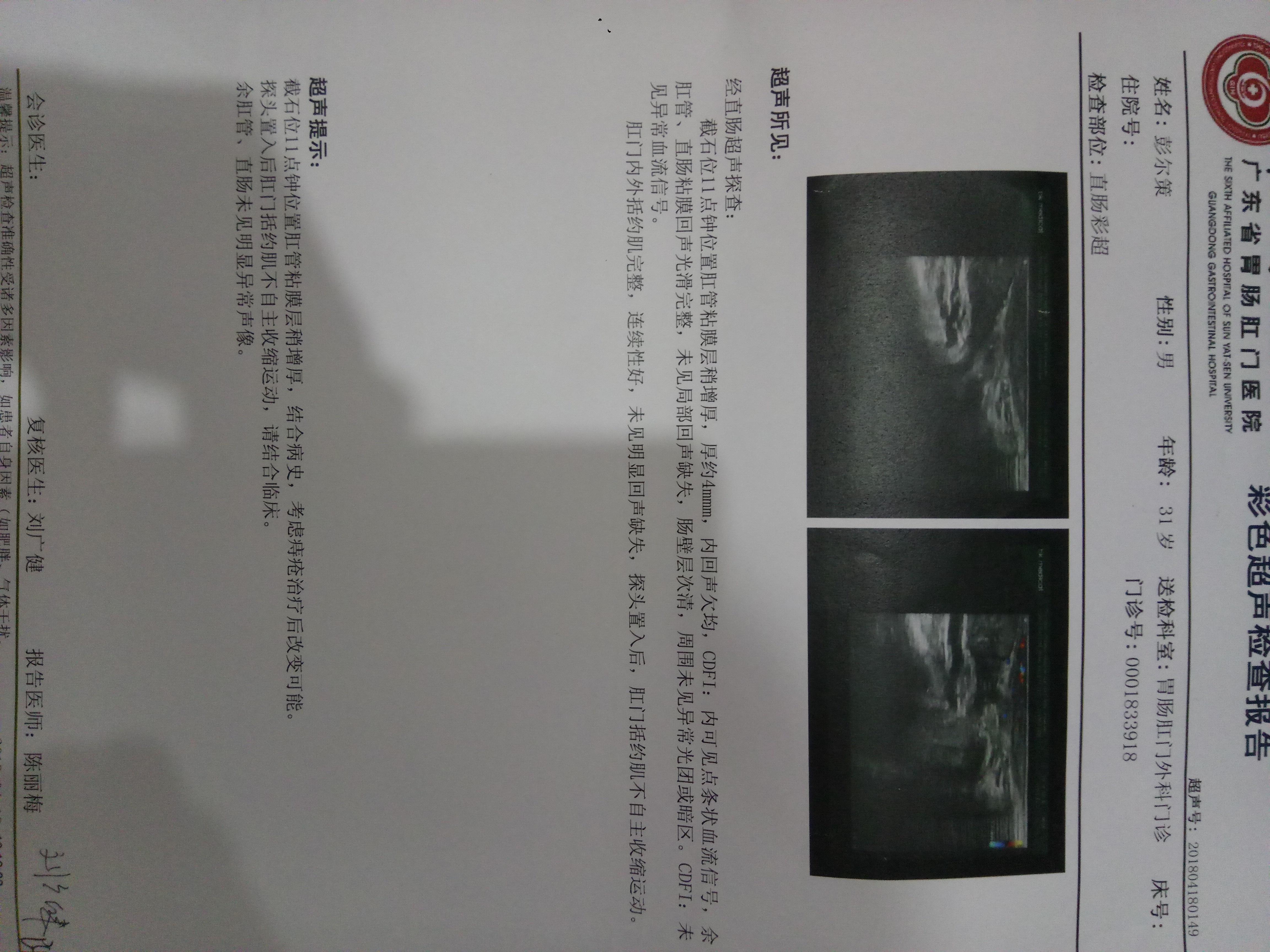 一个半月前内痔注射后肛门坠胀疼痛