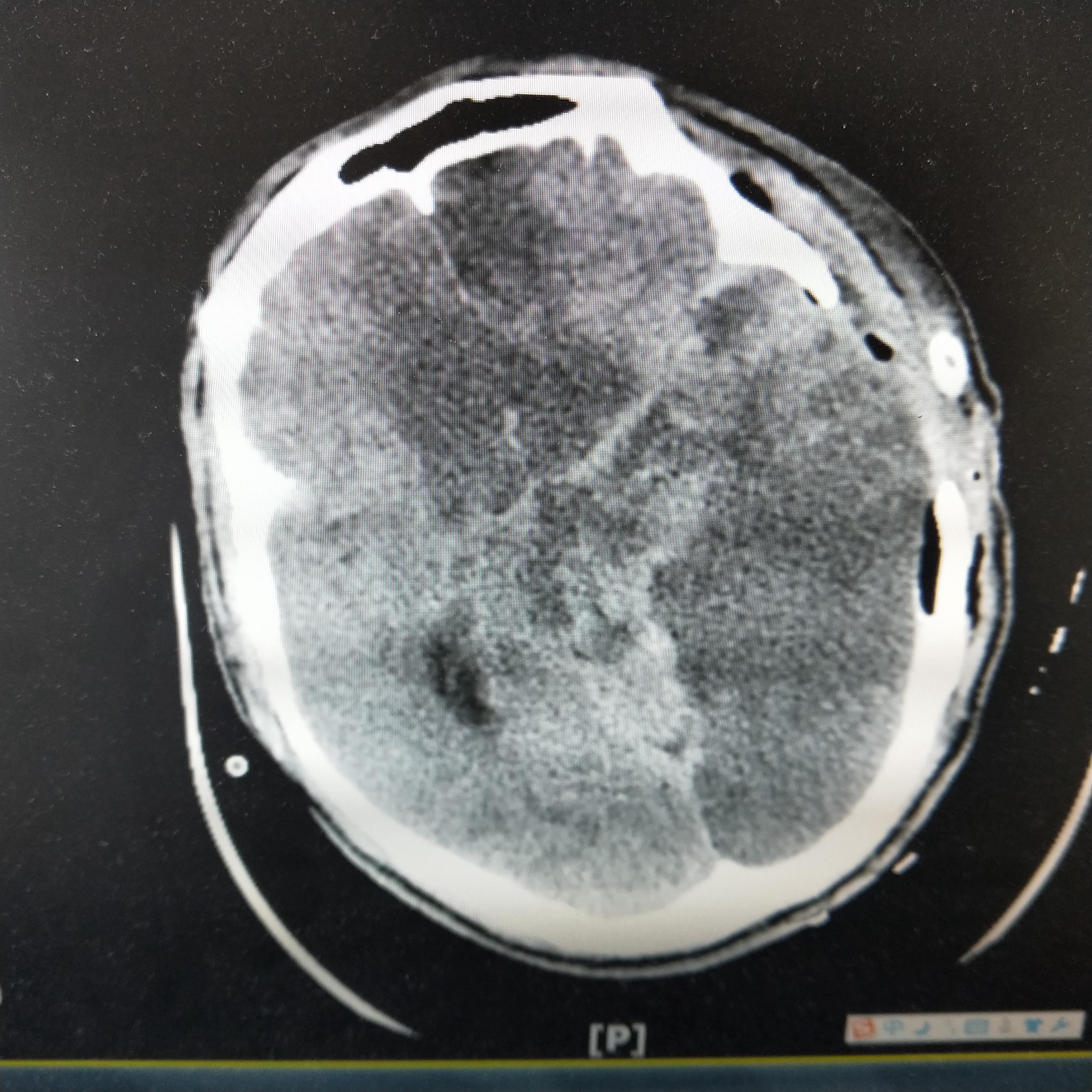 硬膜外血腫開顱血腫清除術後