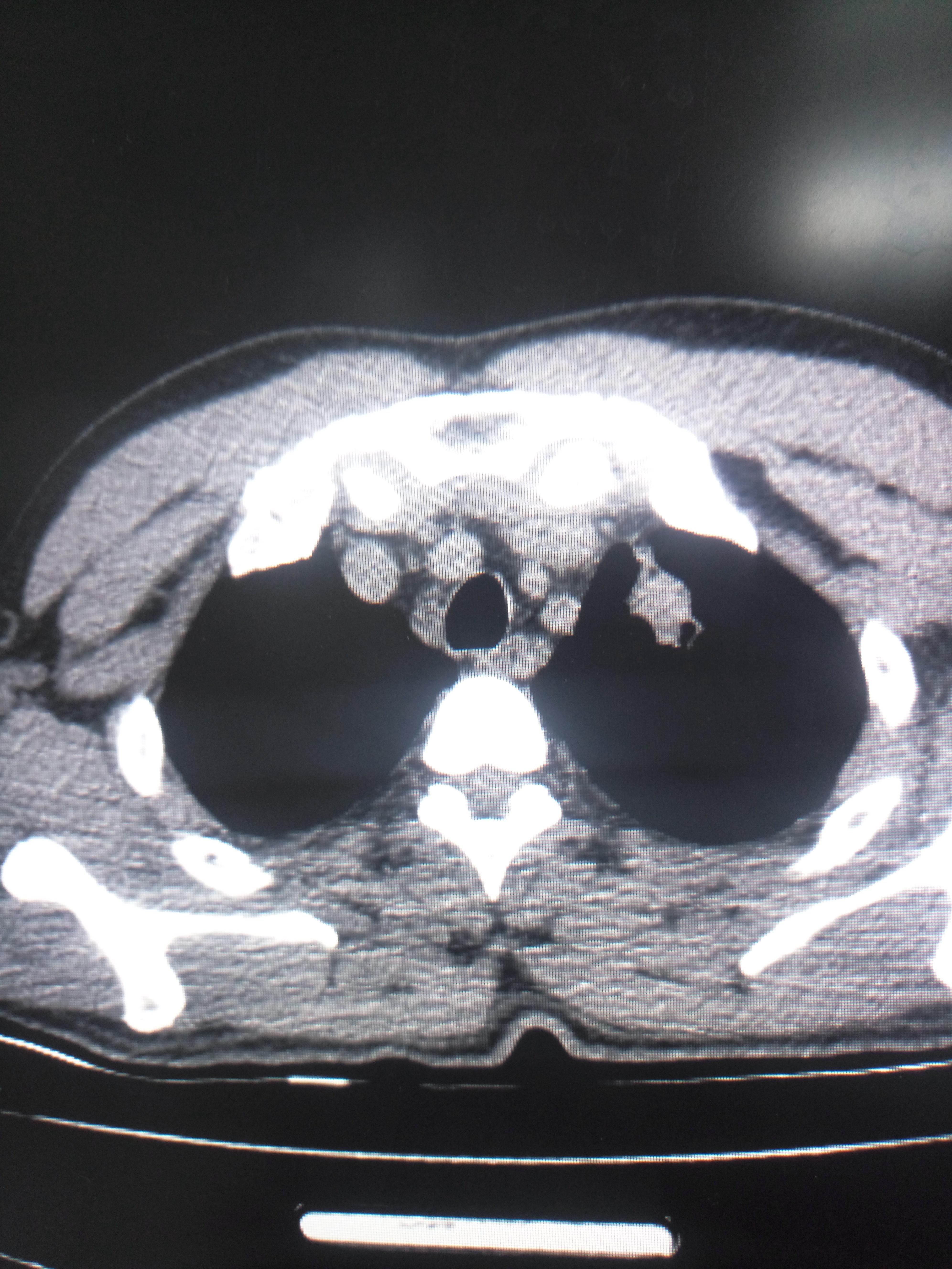 肺部多发病变,请各位老师指导