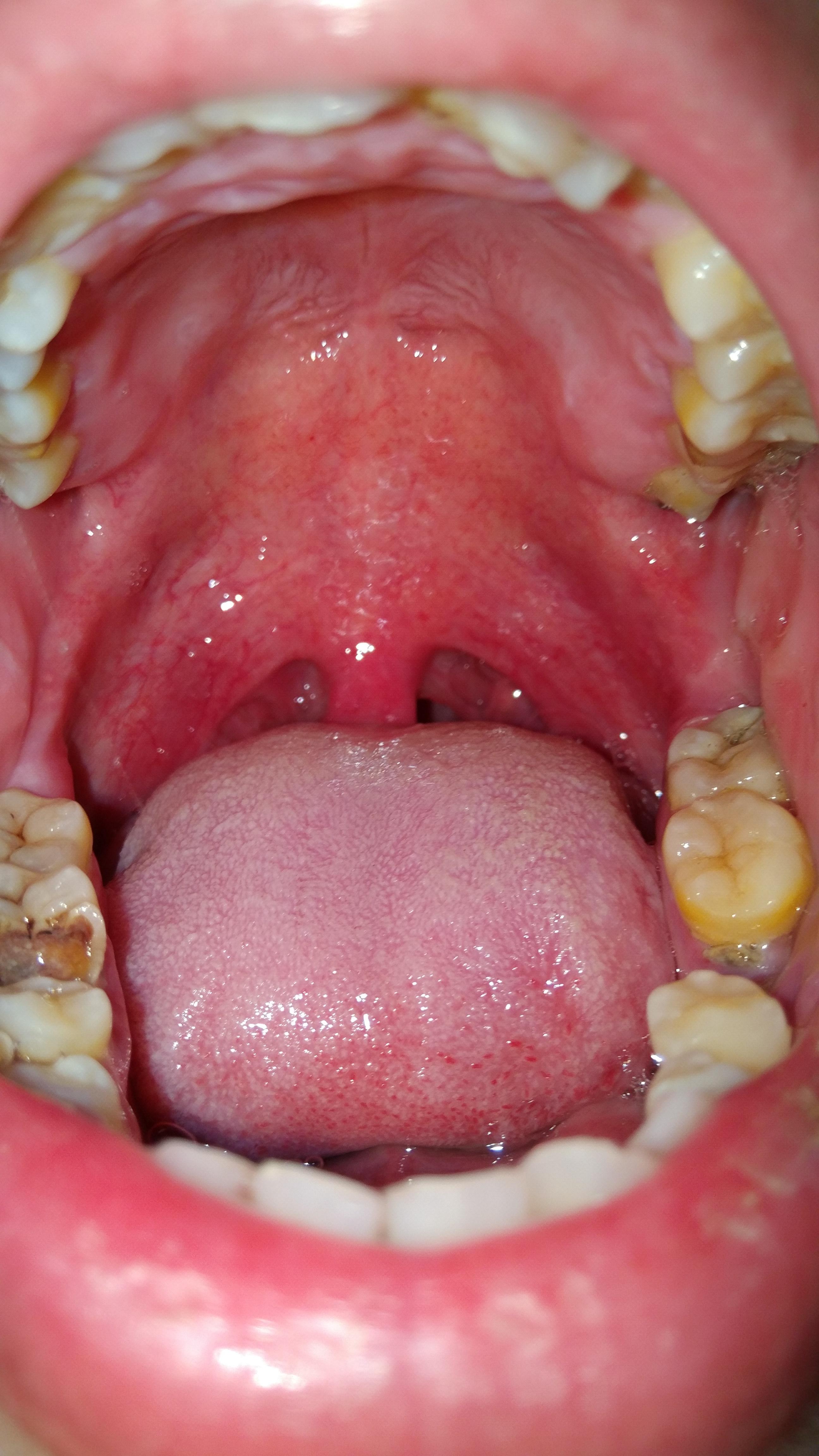 智齿冠周炎的症状图片
