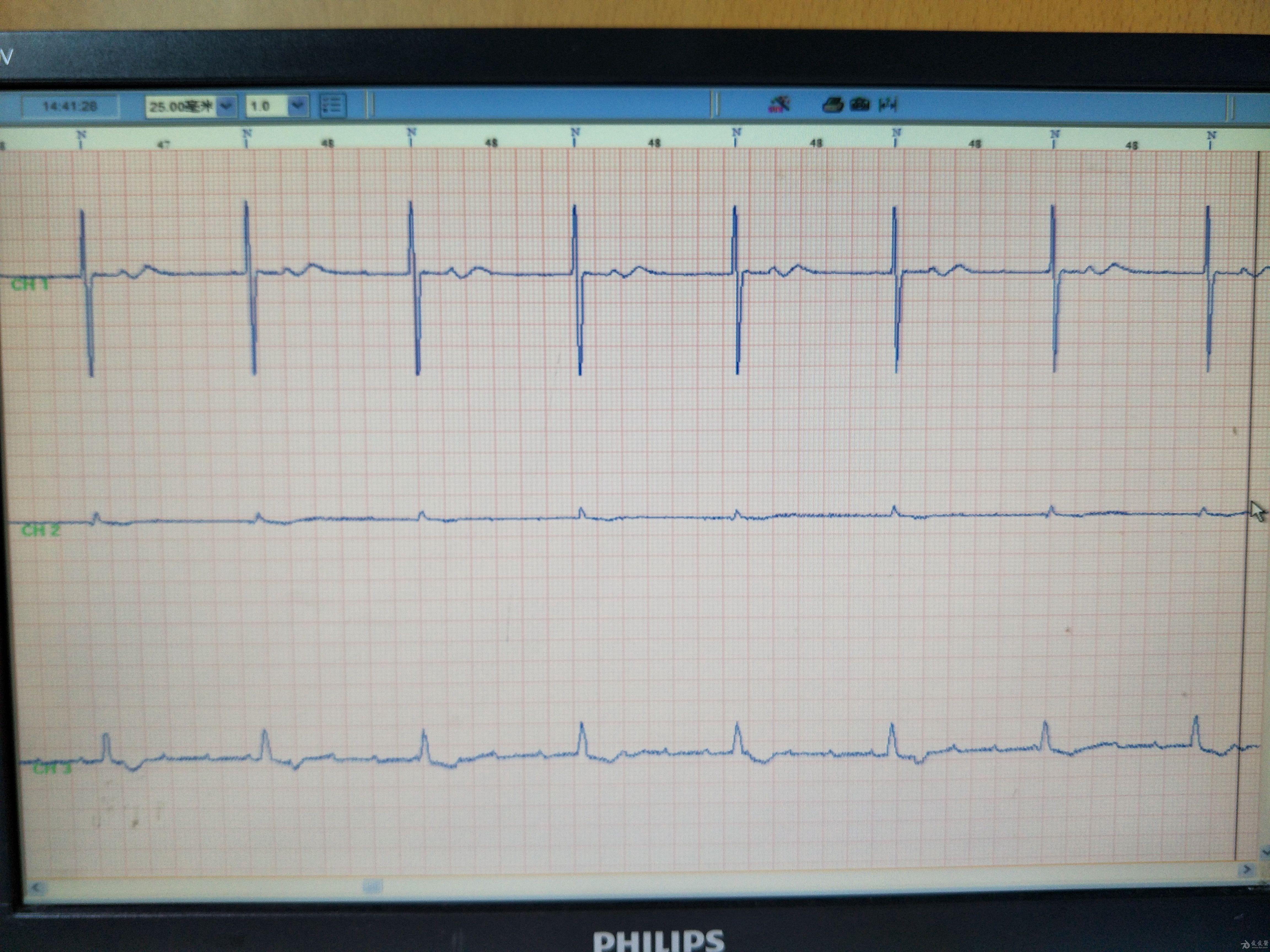 三度传导阻滞心电图图片