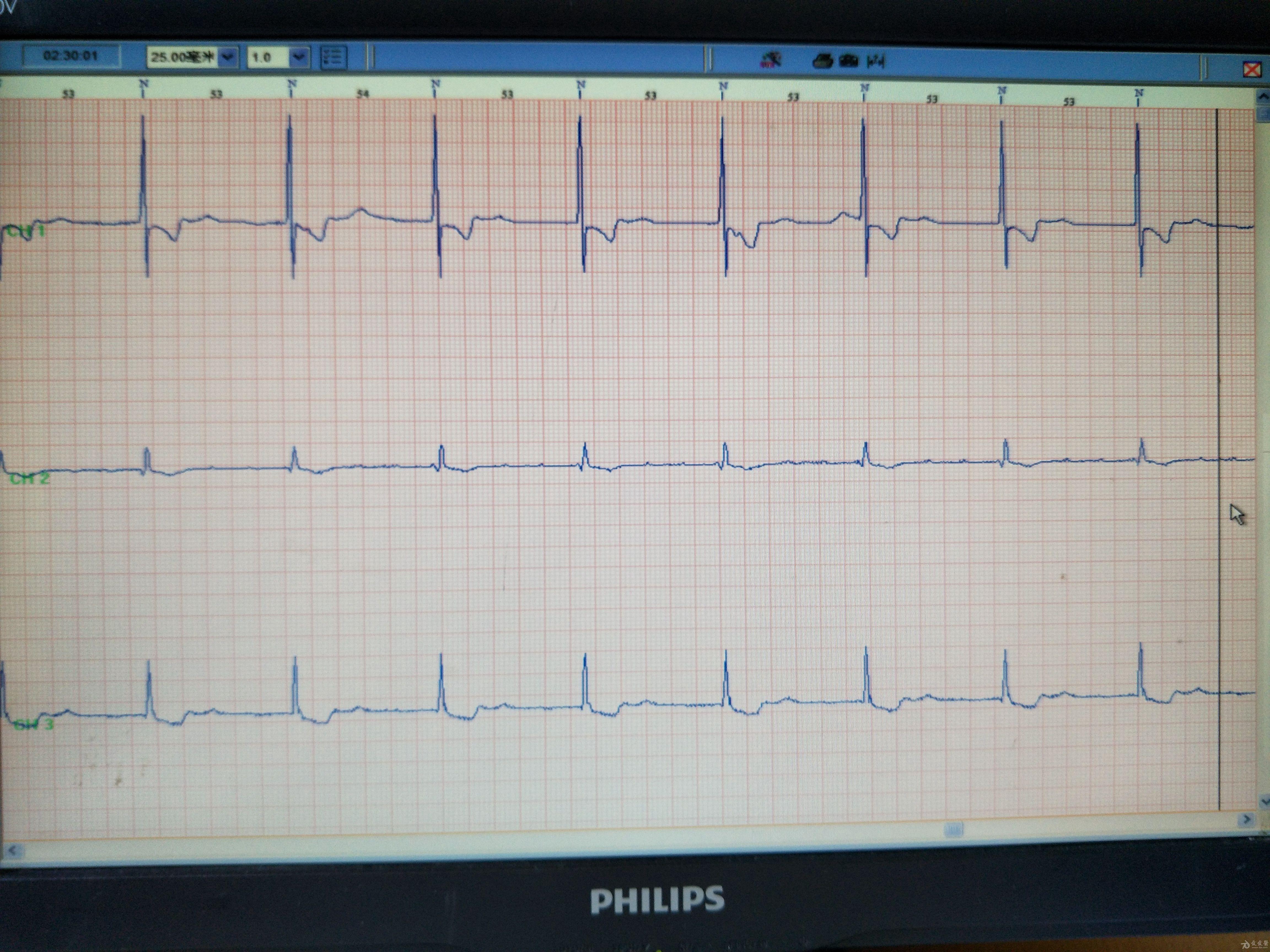 三度传导阻滞心电图图片