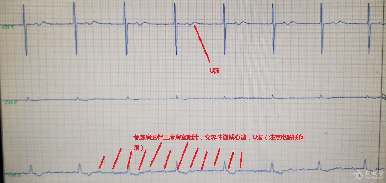 三度高度房室传导阻滞