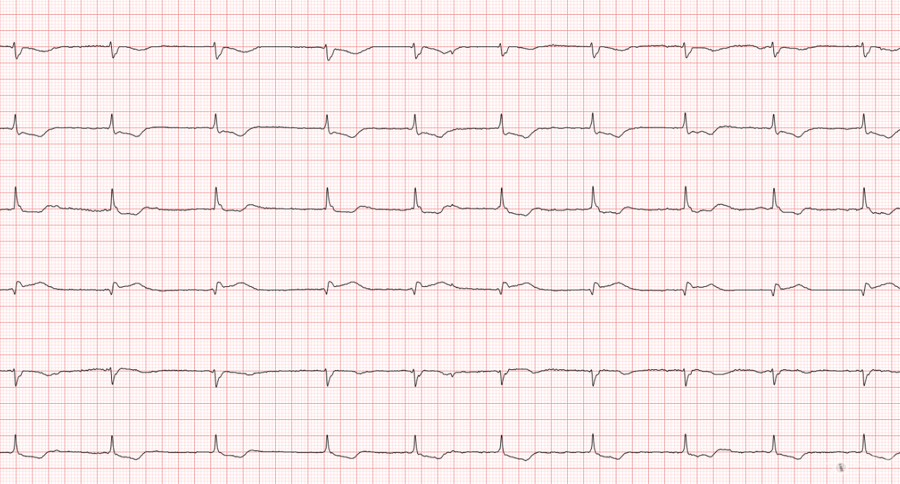 冬秋心电图讨论20180518深倒置t波
