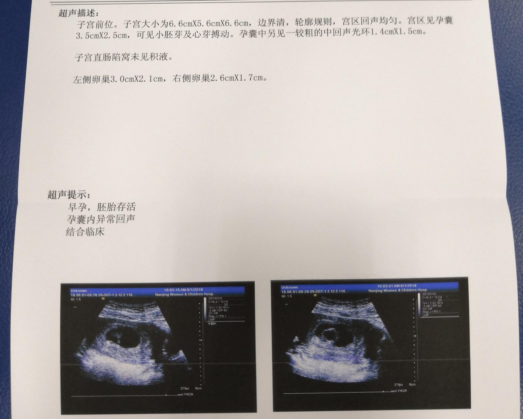 怀孕50天彩超图图片