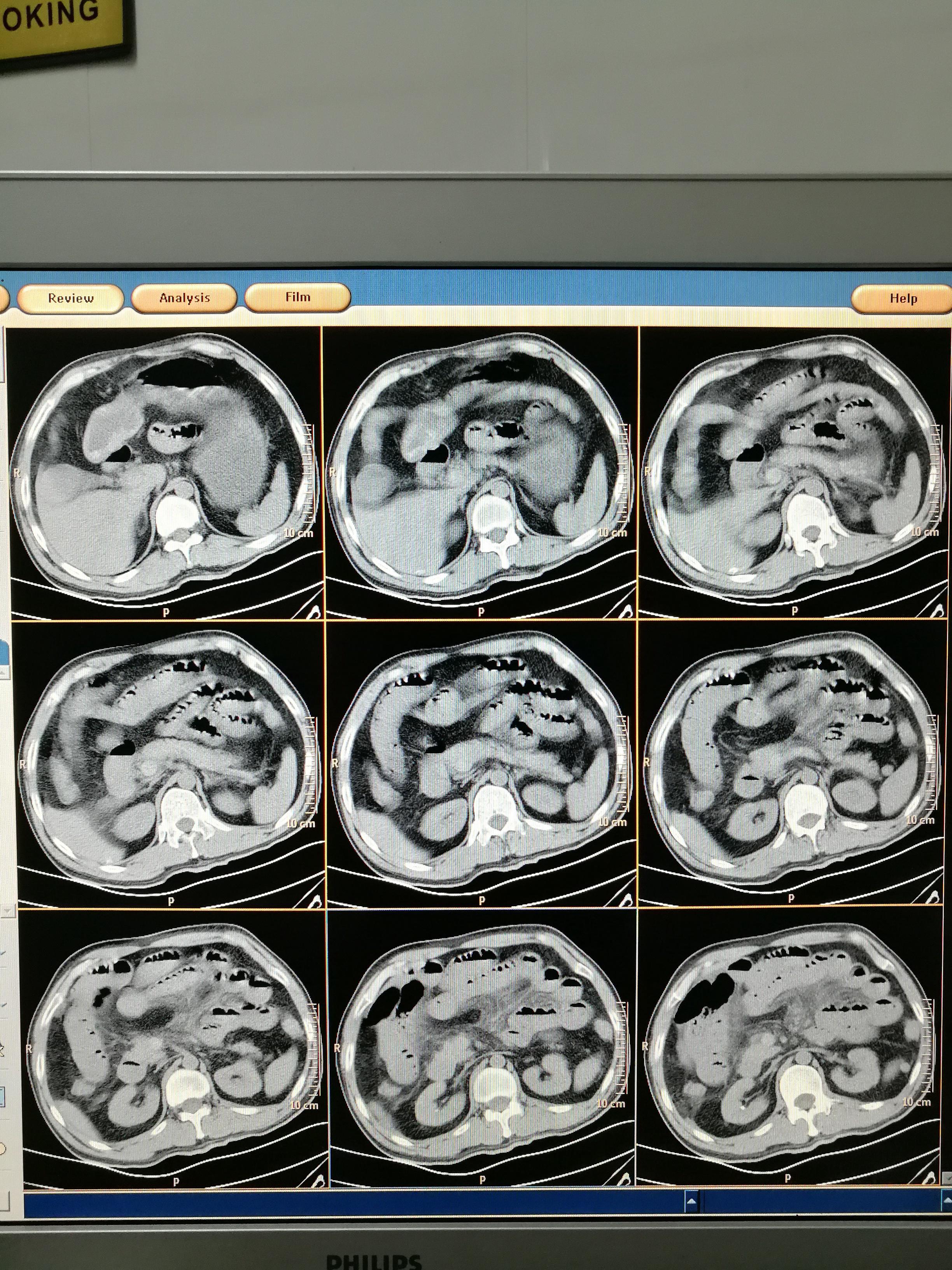 上腹部正常的CT图片图片