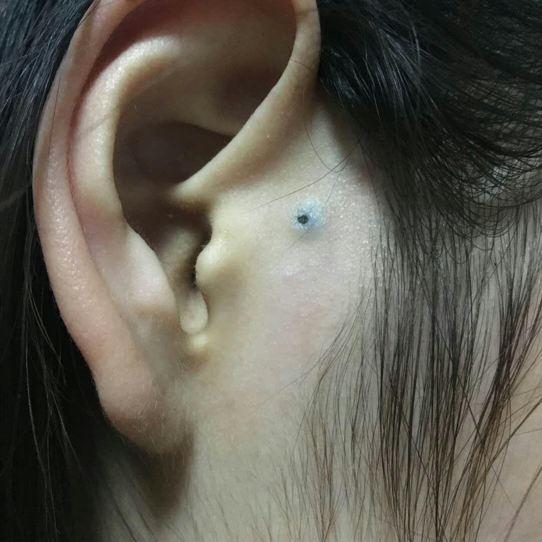 皮肤疾病猜图329扩张孔