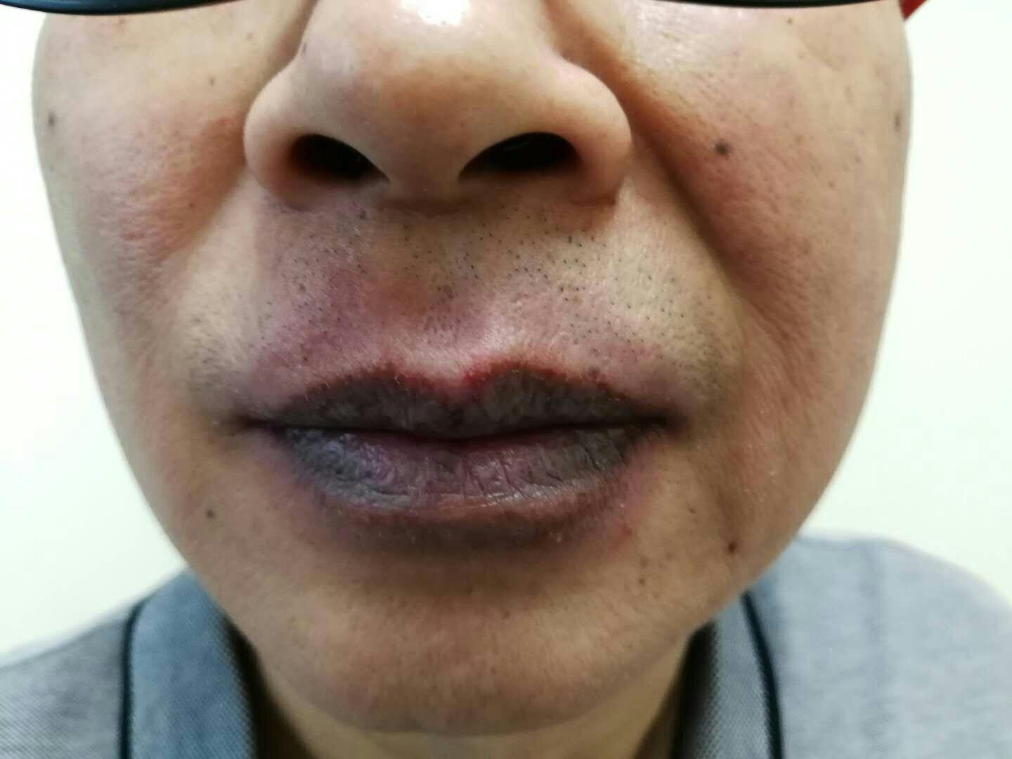 皮肤疾病猜图积分大派送335固定性药疹