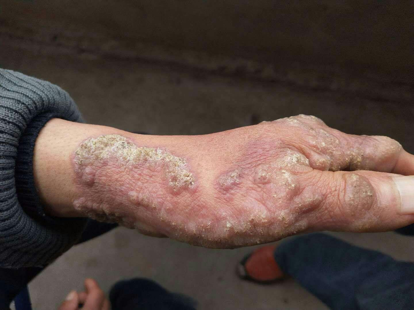 皮肤疾病猜图积分大派送336疣状皮肤结核
