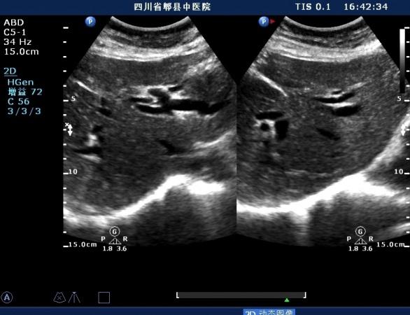 扩张的左肝内胆管