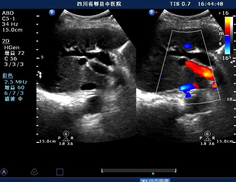 肝内胆管扩张超声图片