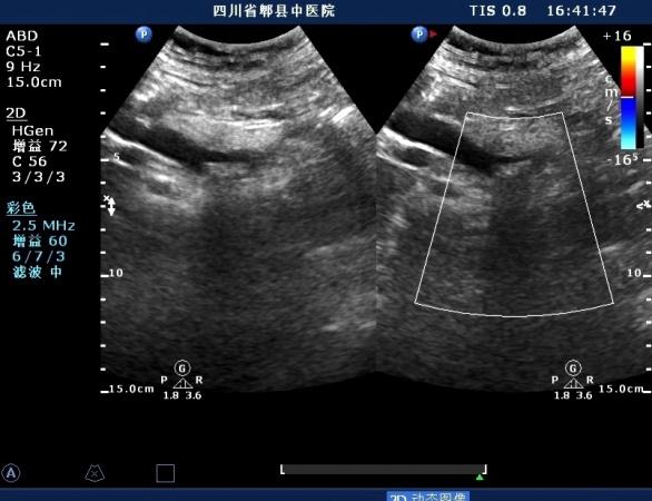 胆总管胰腺段结石