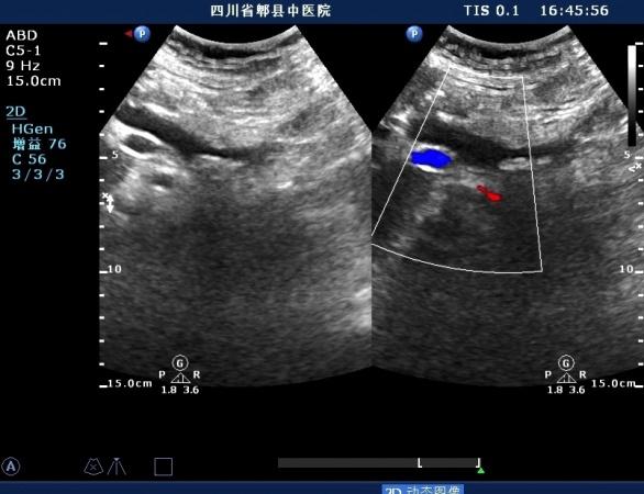 胆总管胰腺段结石