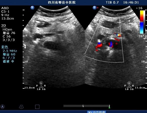 胆总管胰腺段结石