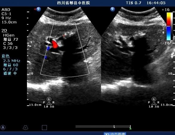 左肝内胆管结石