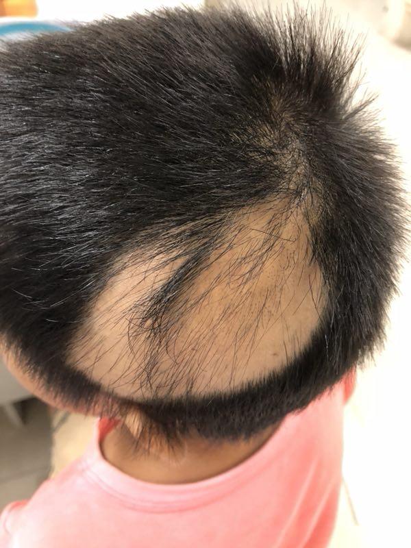 皮肤疾病猜图,积分大派送——343拔毛癖 - 全科医