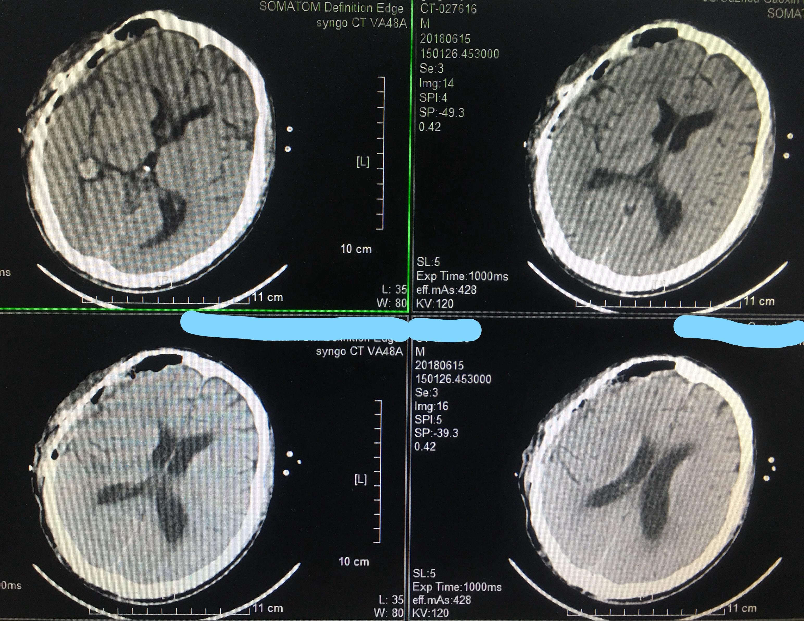 奇怪的修补后硬膜外血肿一