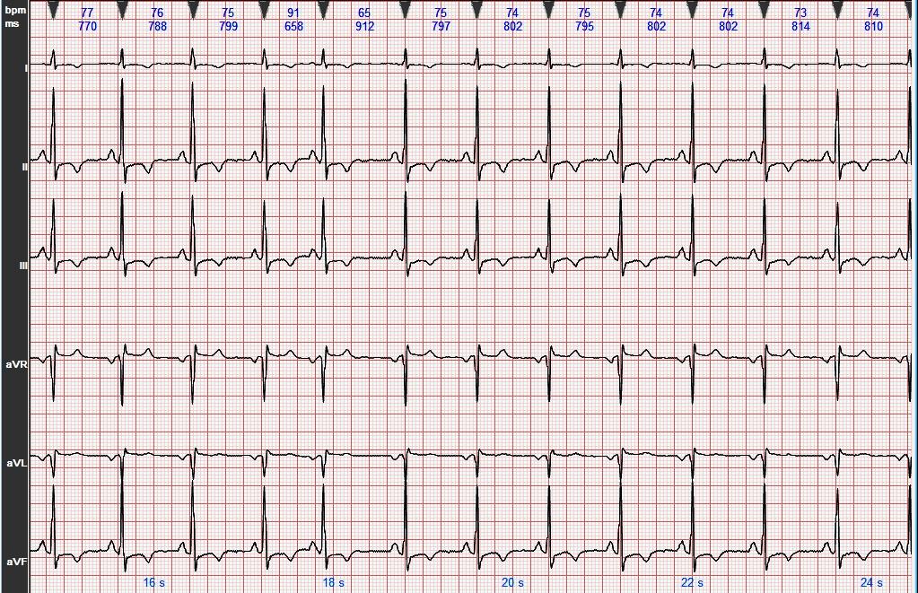 心电图学习20180717
