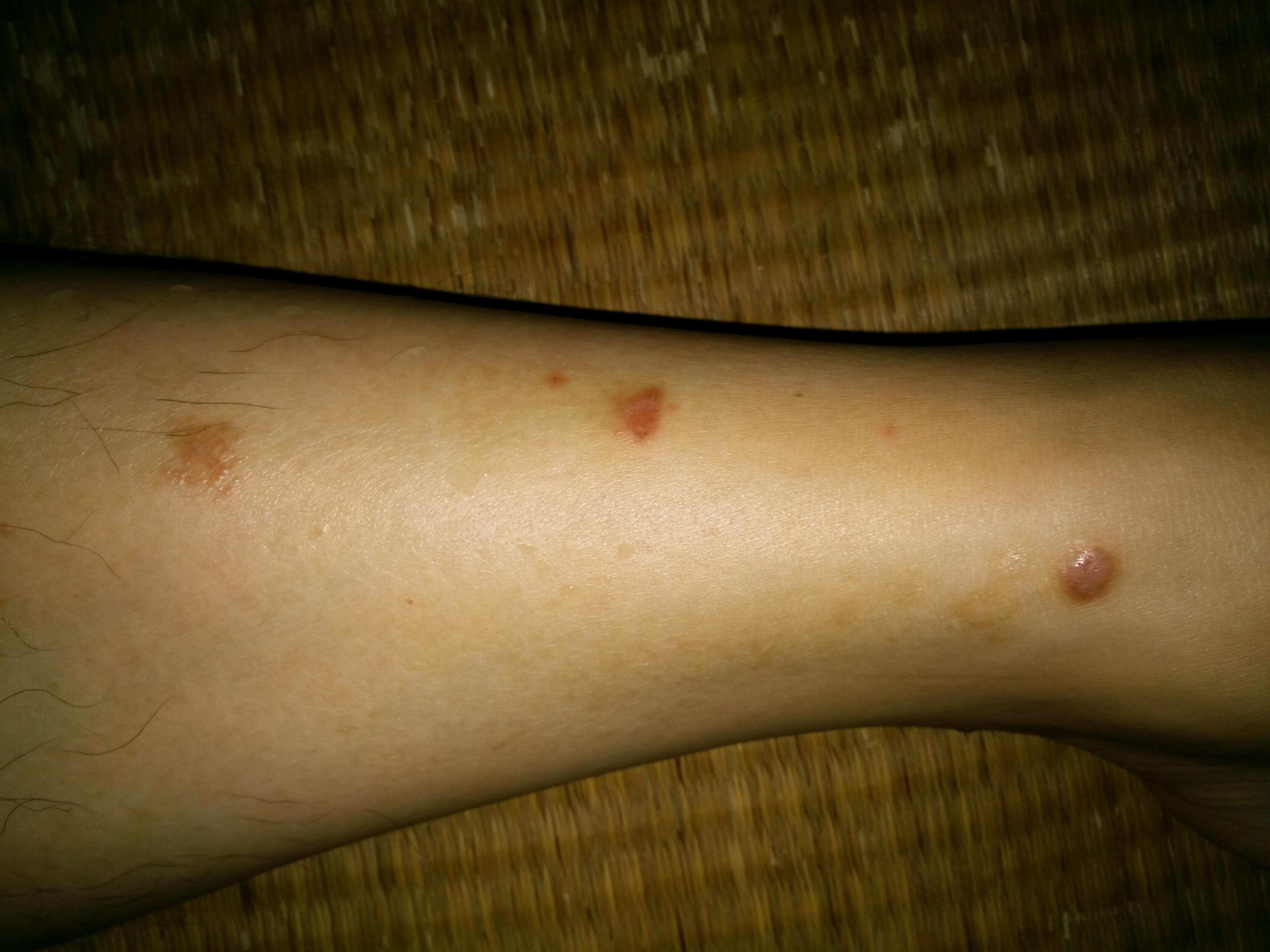 棘手皮疹请高手支招