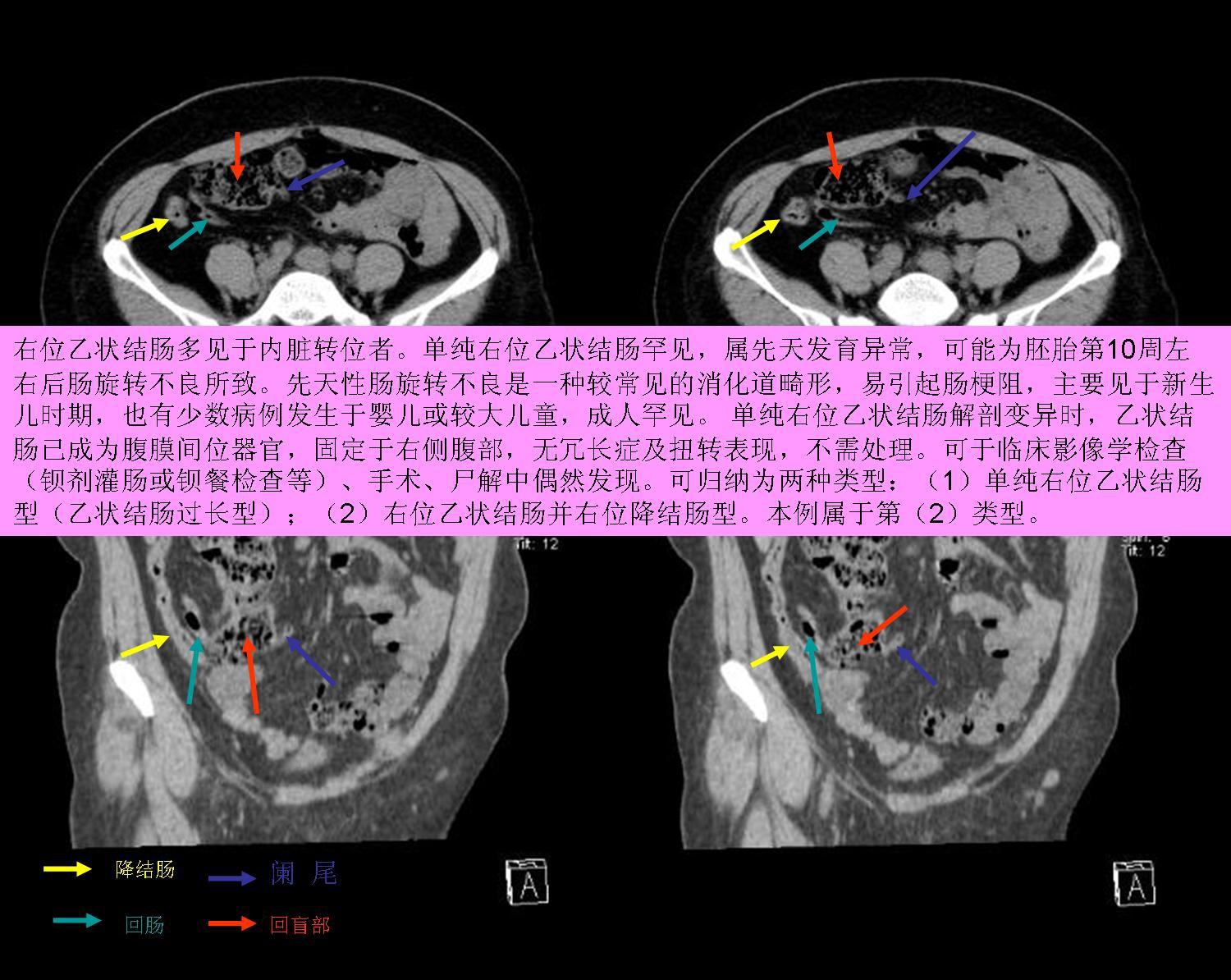 降结肠乙状结肠转位一例