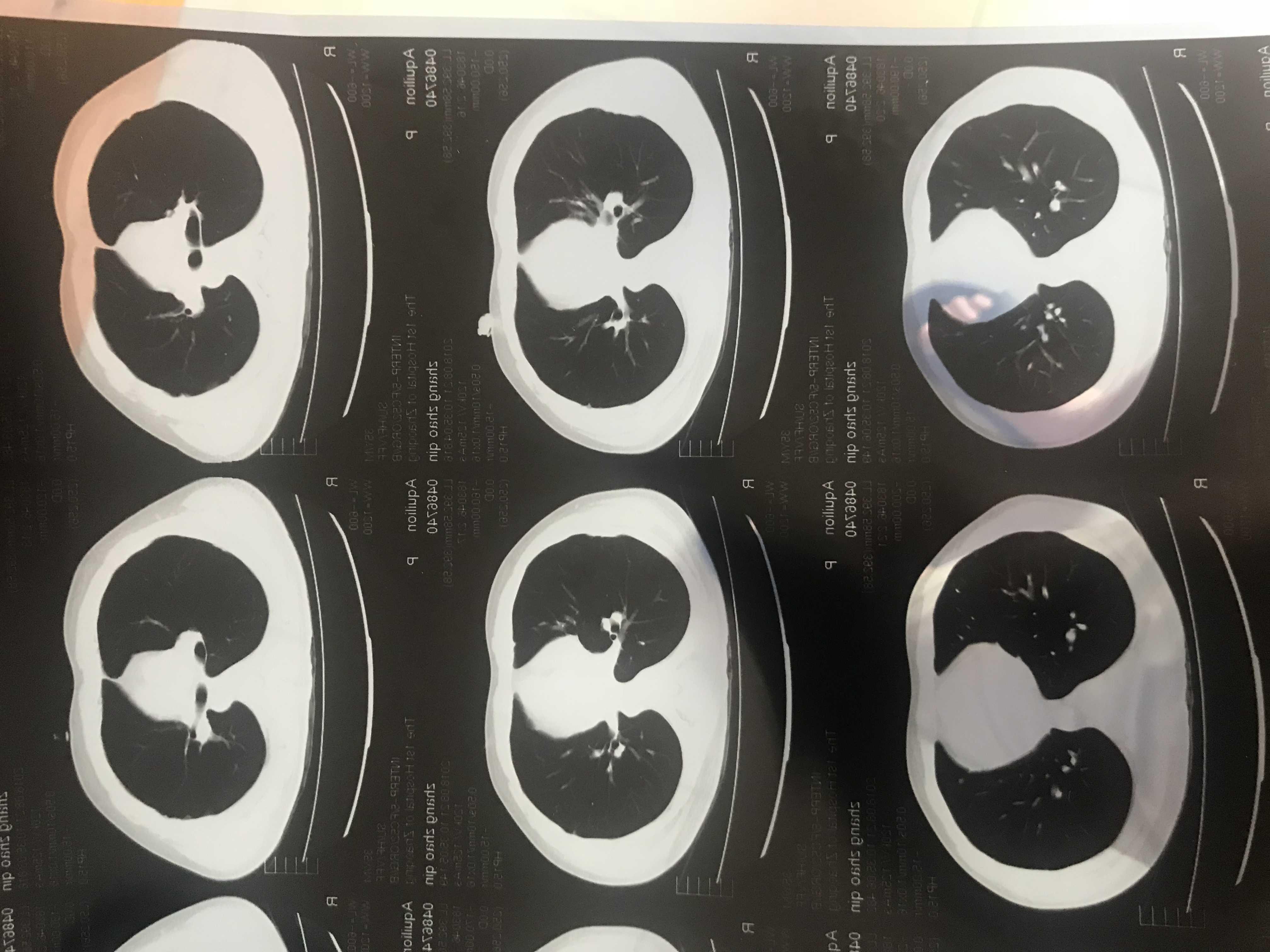 求助双上肺纤维硬结灶双侧胸膜增厚