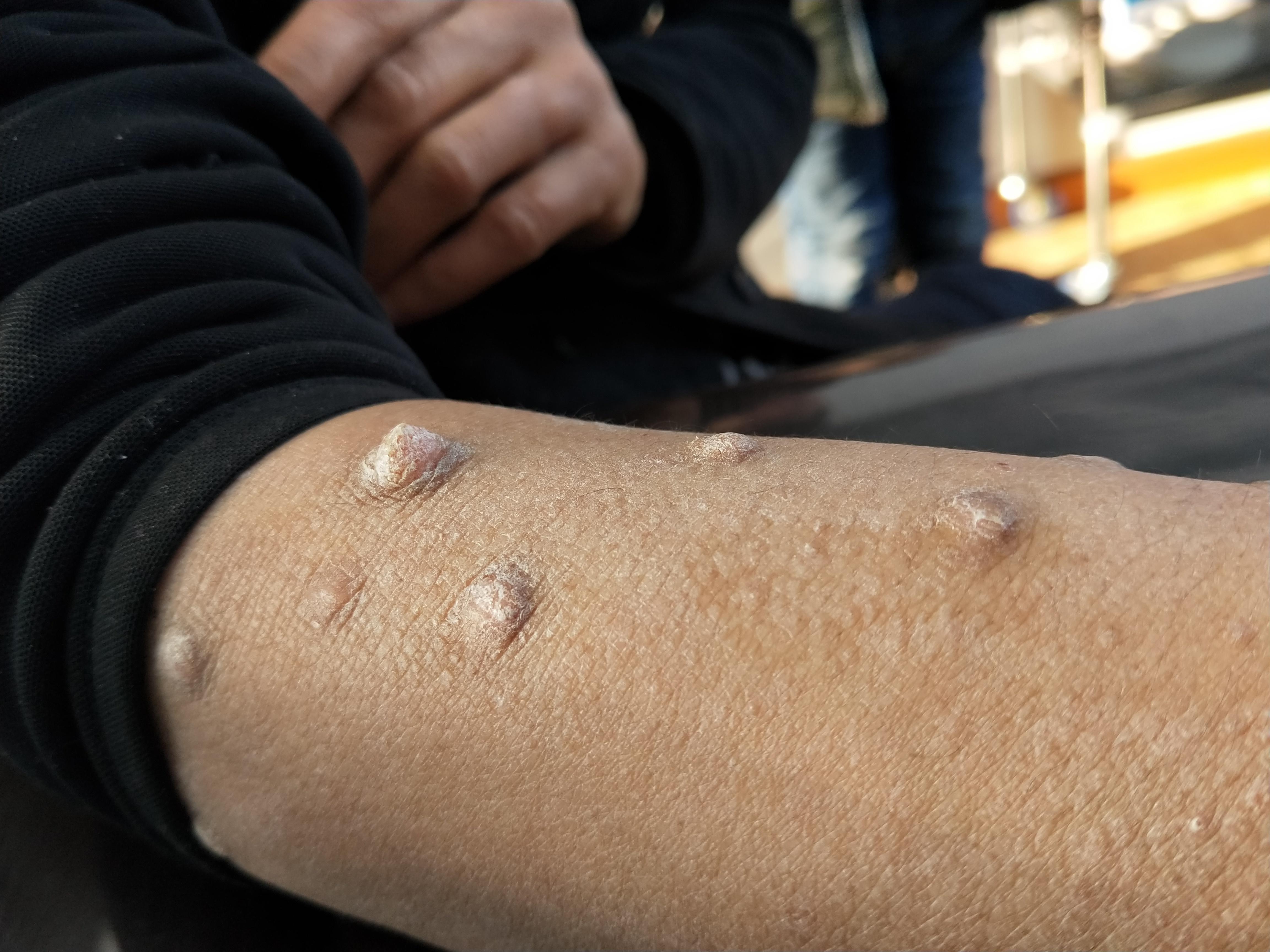 典型的皮肤病图片