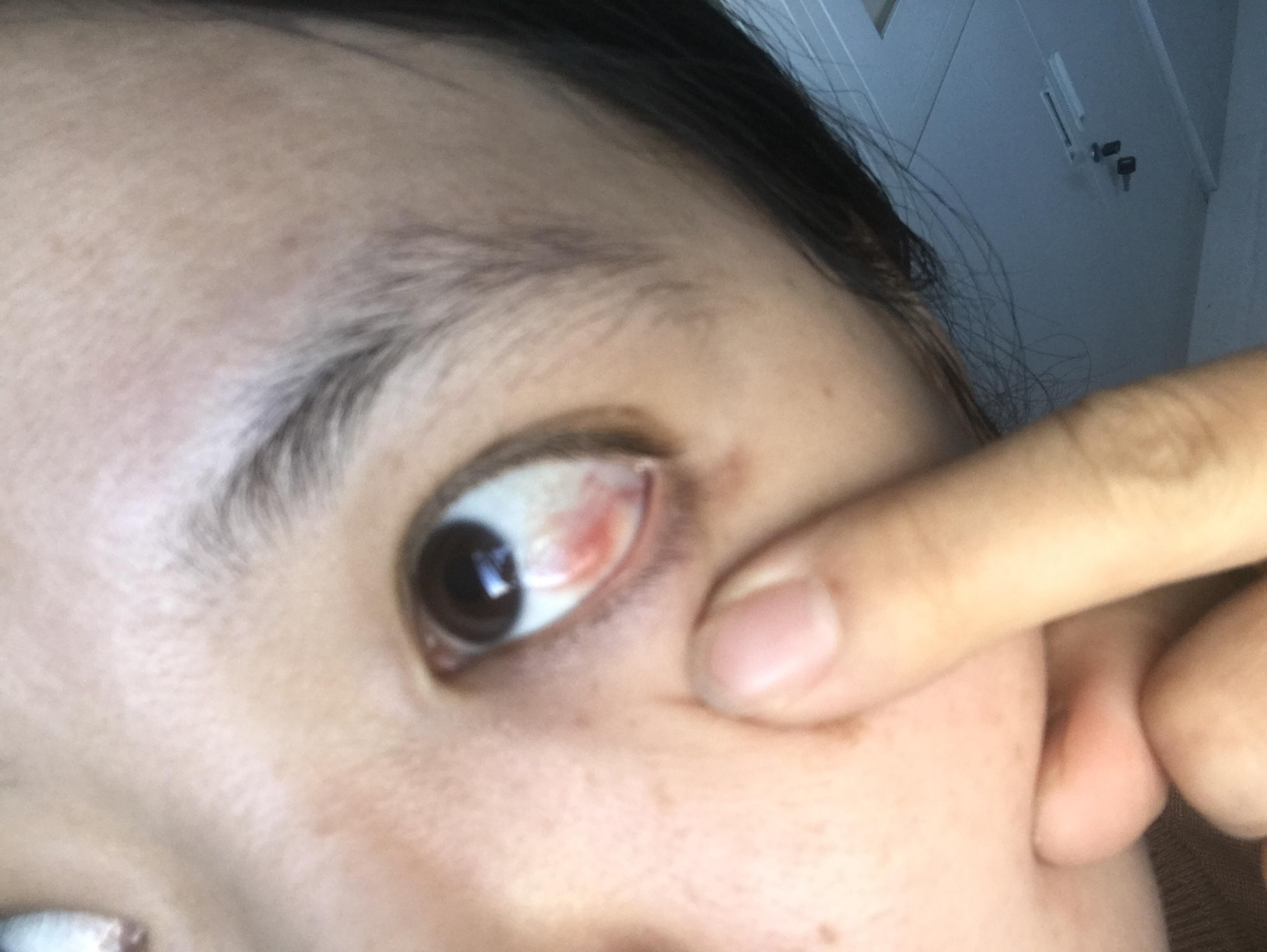 我昨天刚刚收集的双眼结膜脂肪瘤