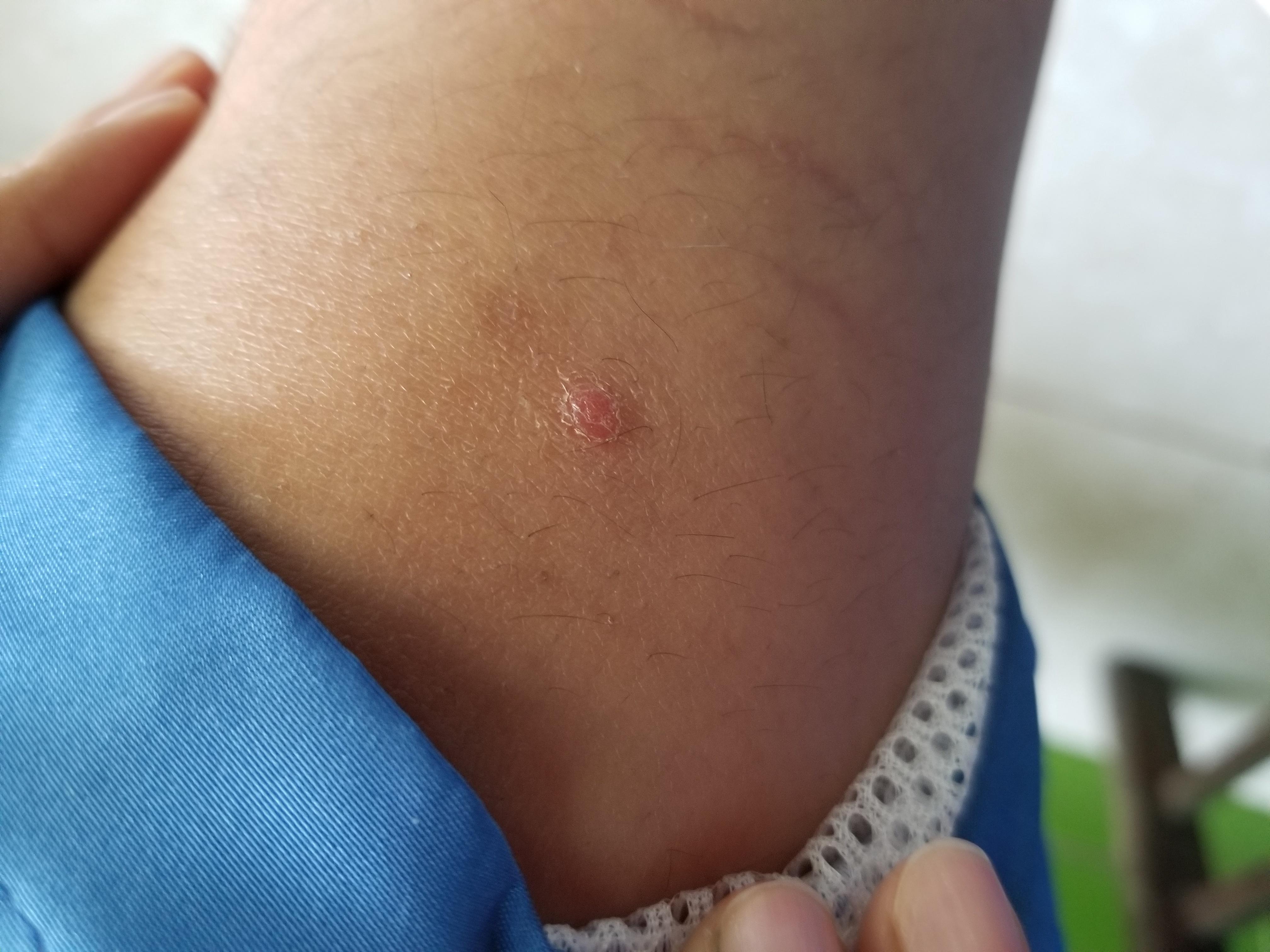 下肢条形红斑,求诊断