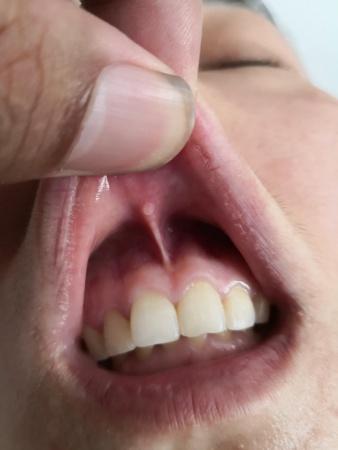 唇系带痔疮诊断