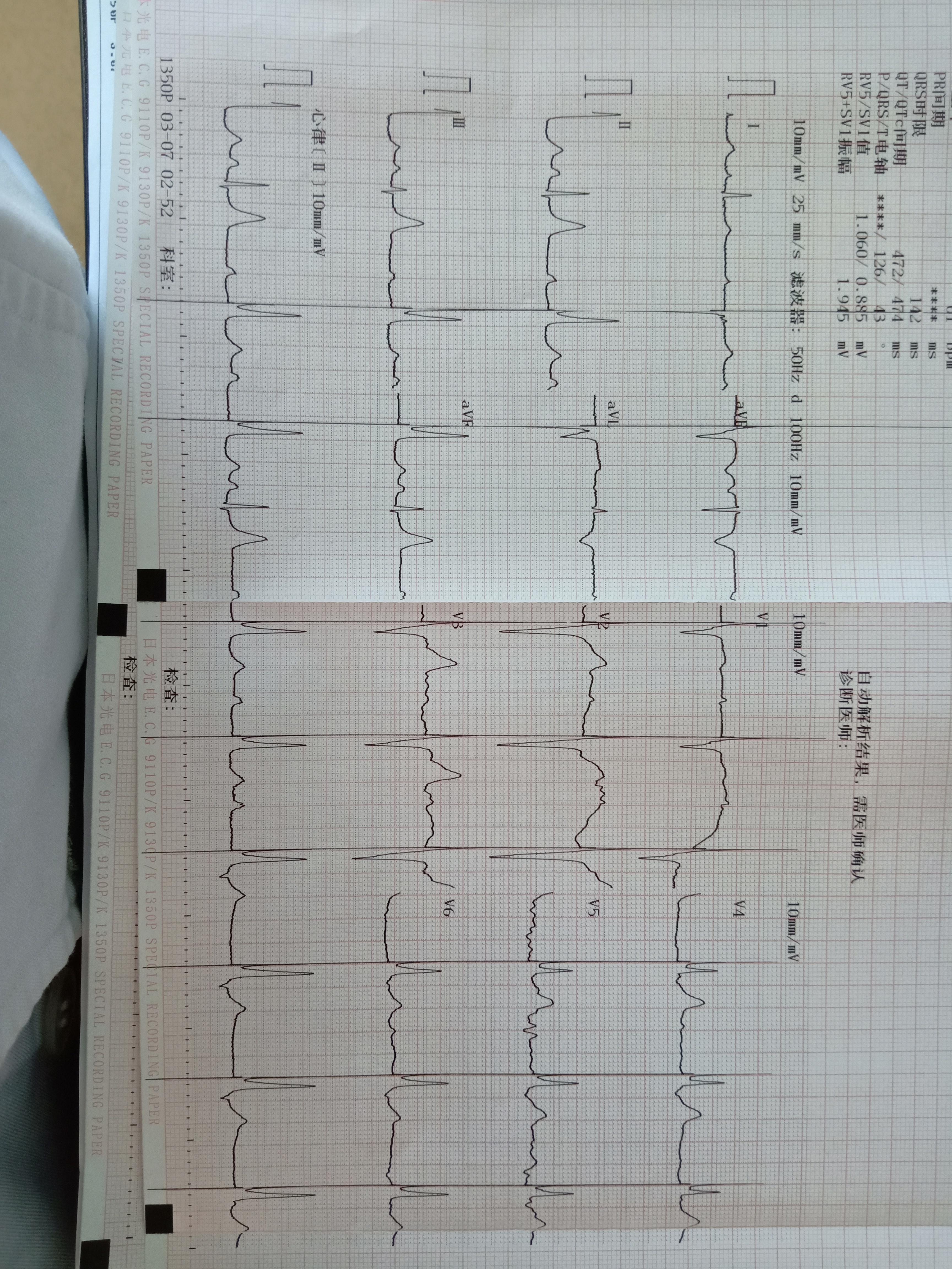 起搏器心律心电图报告图片