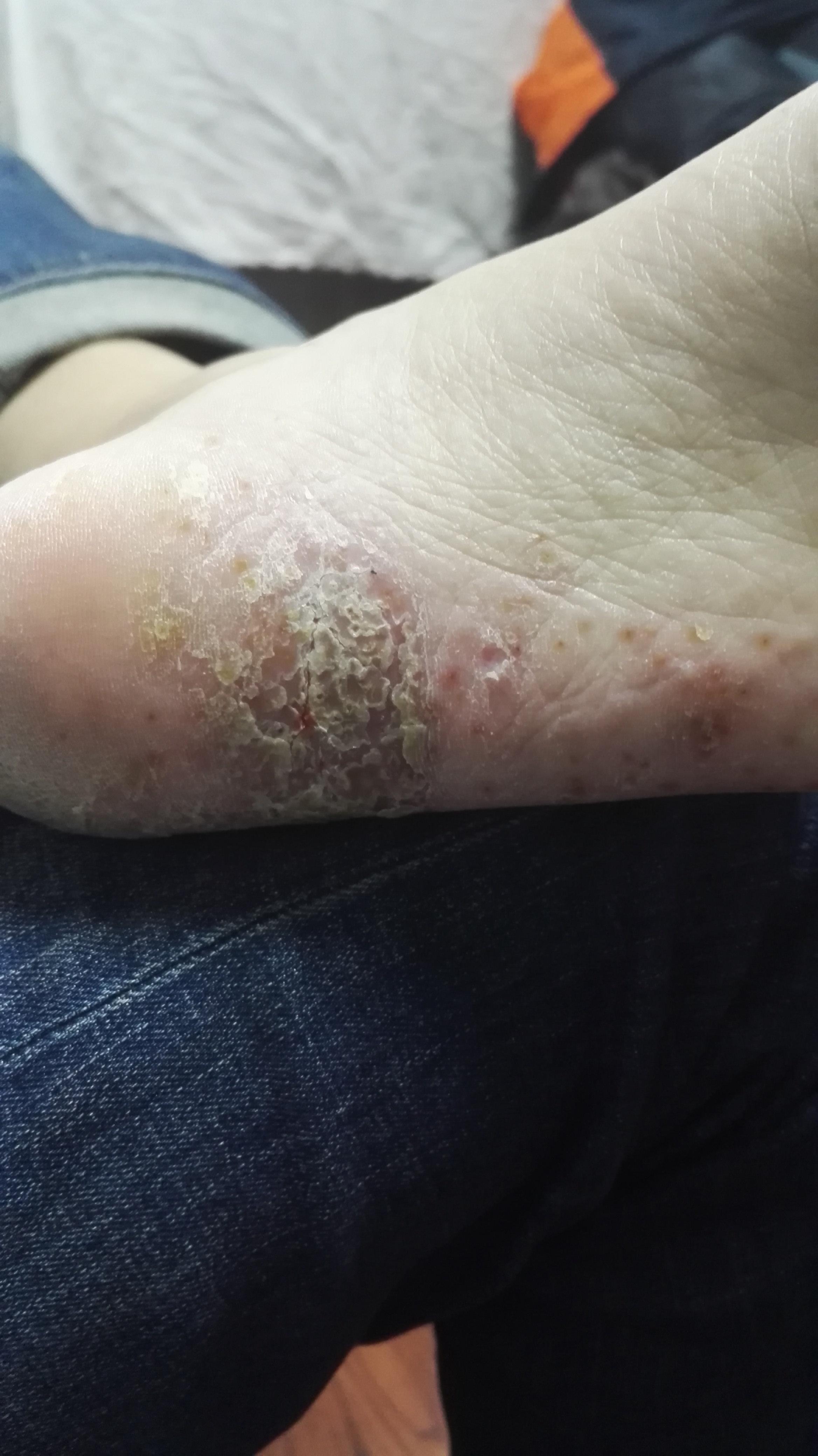请问脚底是湿疹吗