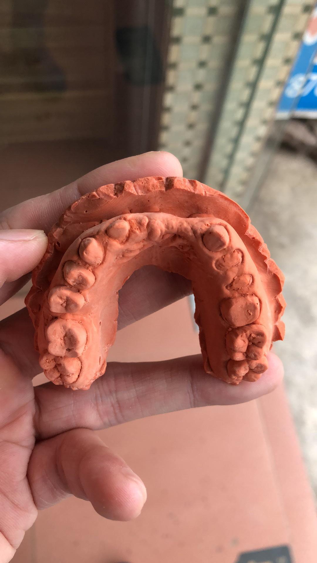 此患者适合全瓷冠桥修复吗?