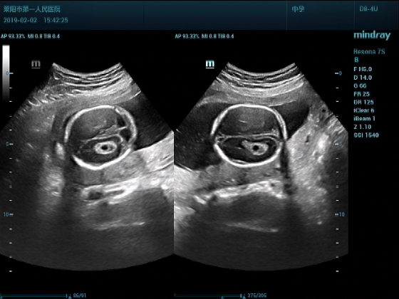 胎儿脉络丛囊肿图片图片