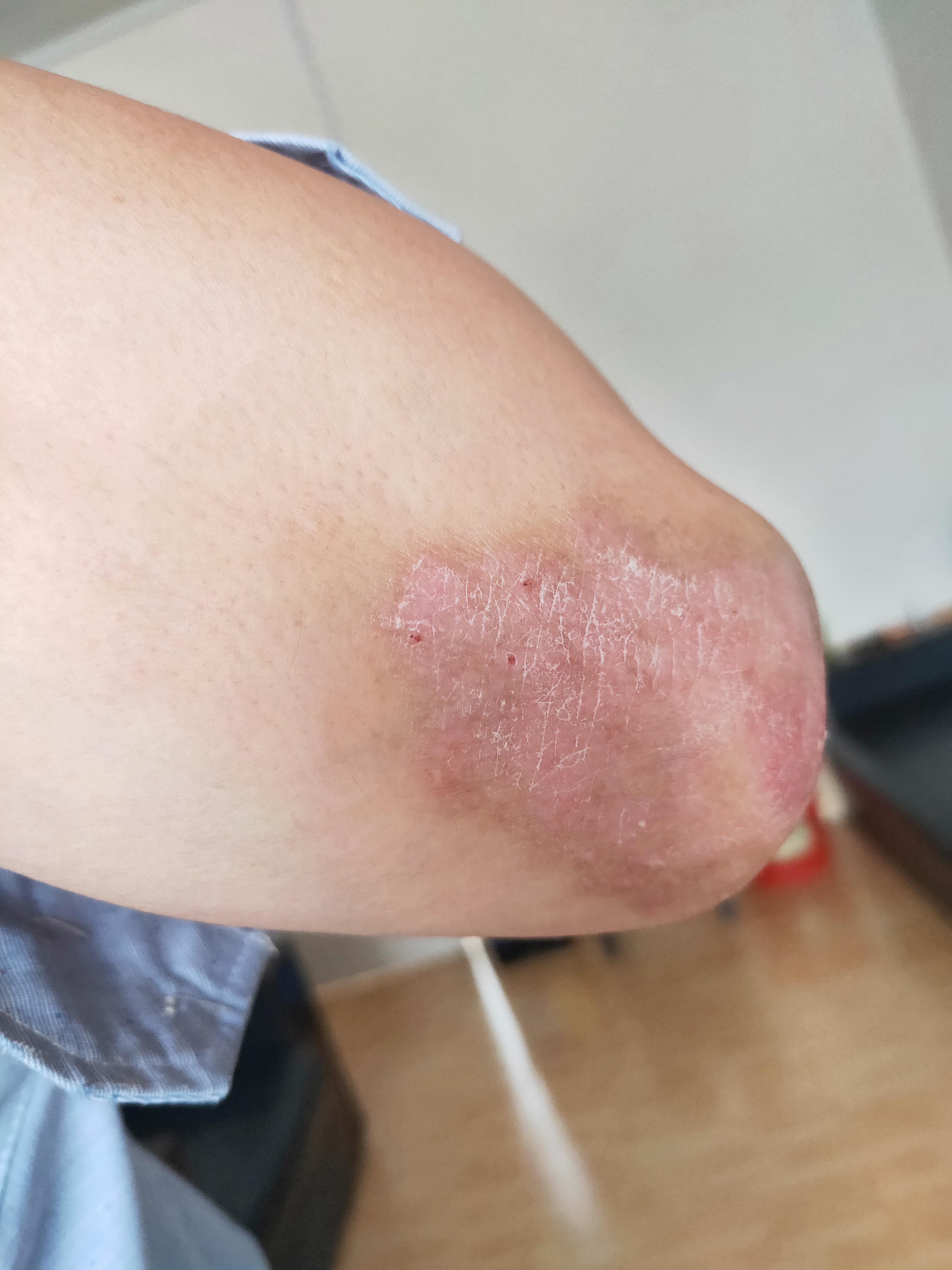 求助各位老师哪里有治疗牛皮癣中医大夫