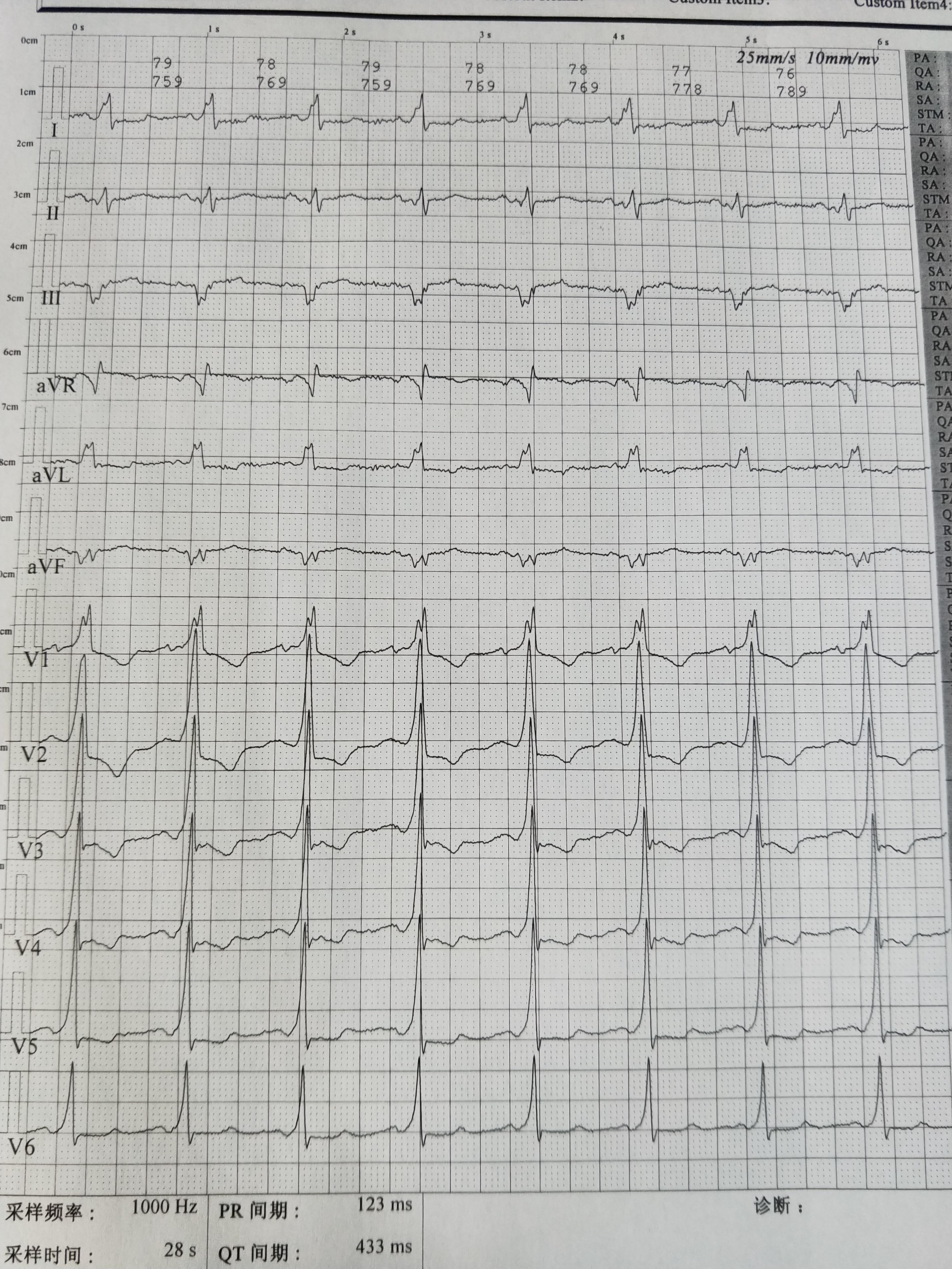 心电图P112ms图片