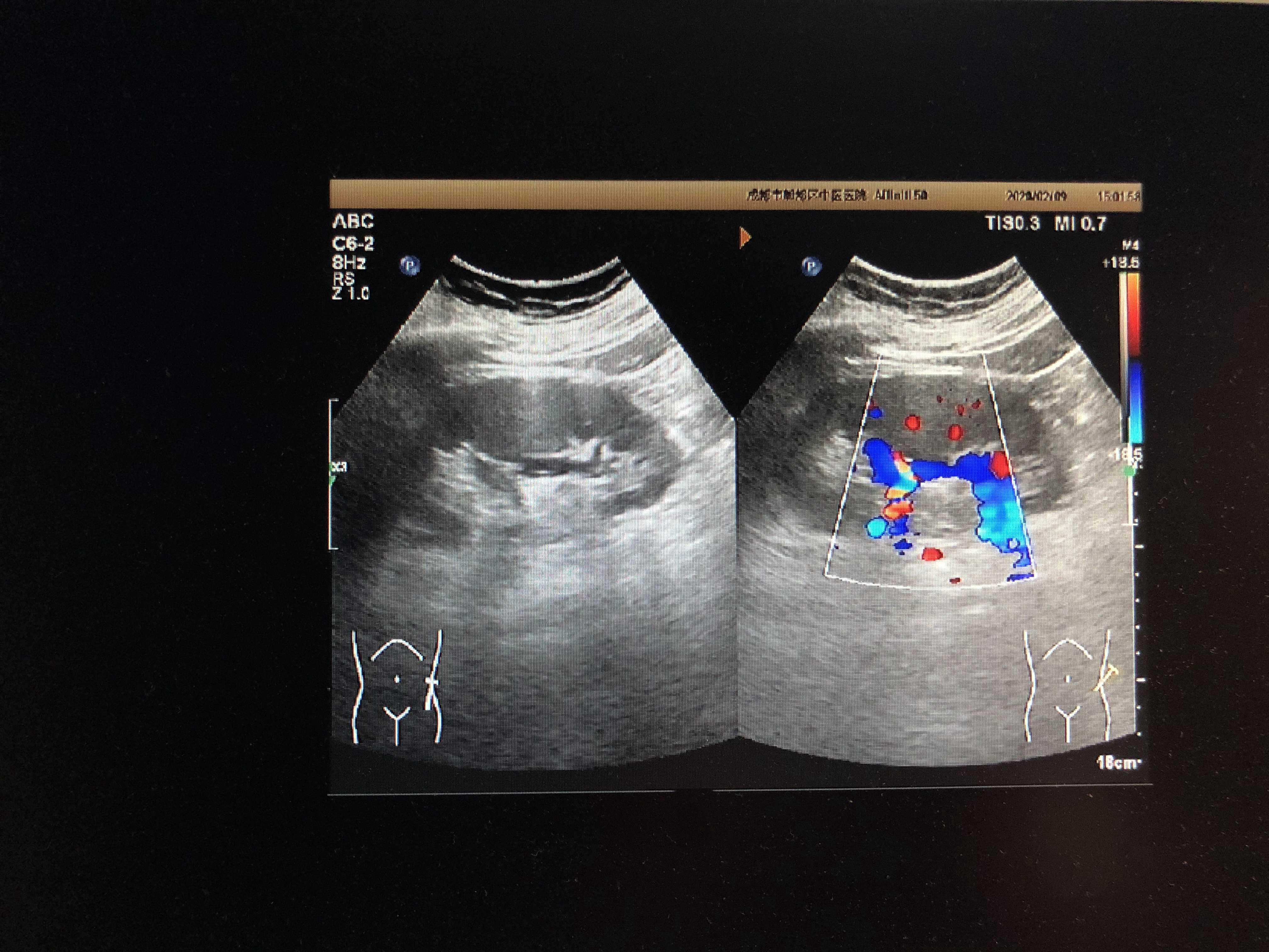 肾动脉解剖位置超声图图片