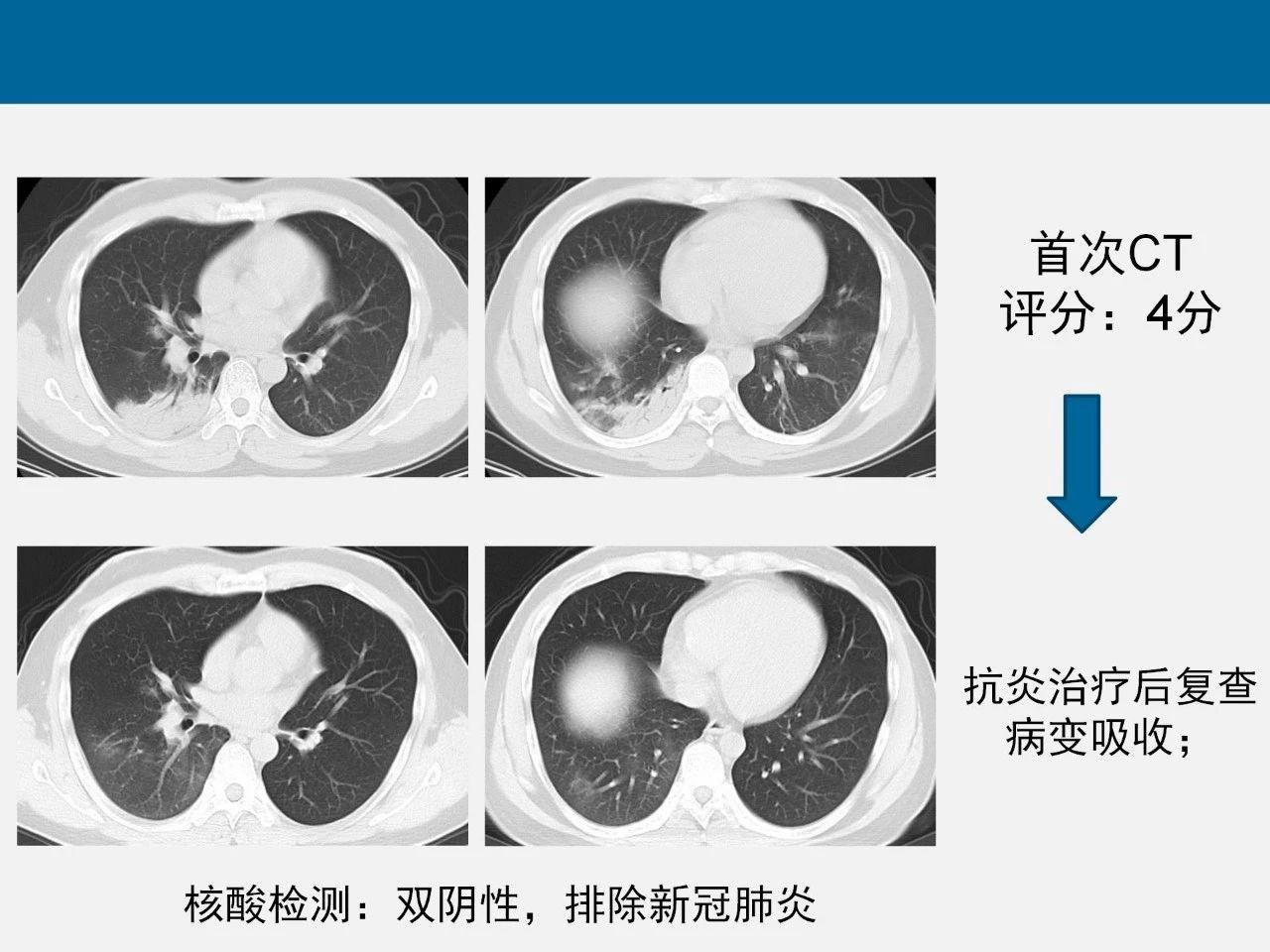 新型冠状病毒肺炎ct评分及应用