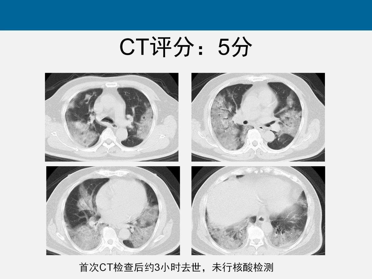 Ct 肺炎 早期コロナ肺炎のCT画像（医師向け）｜Dr.和の町医者日記