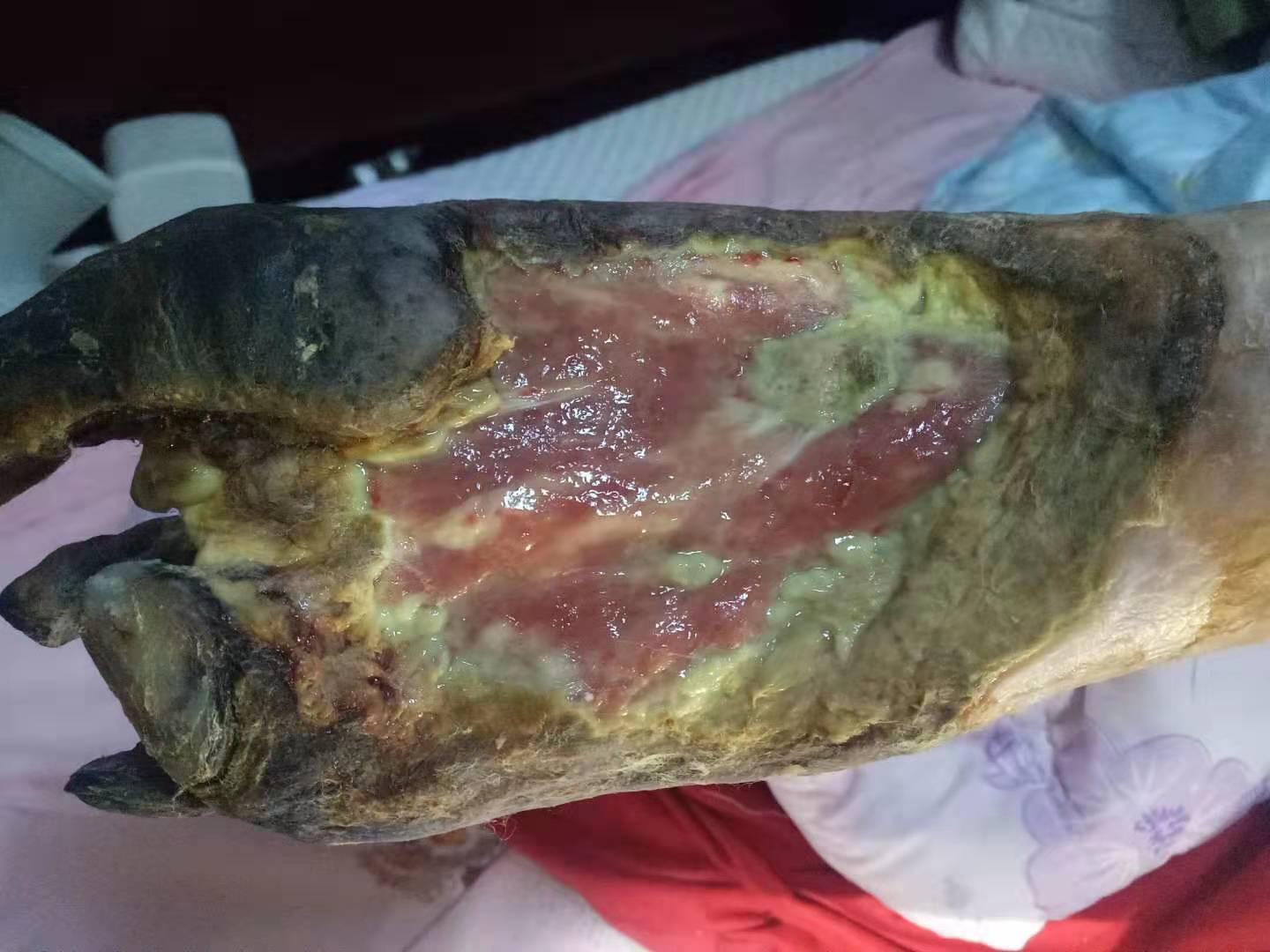 纯中医治疗糖尿病烂脚七个月的图片