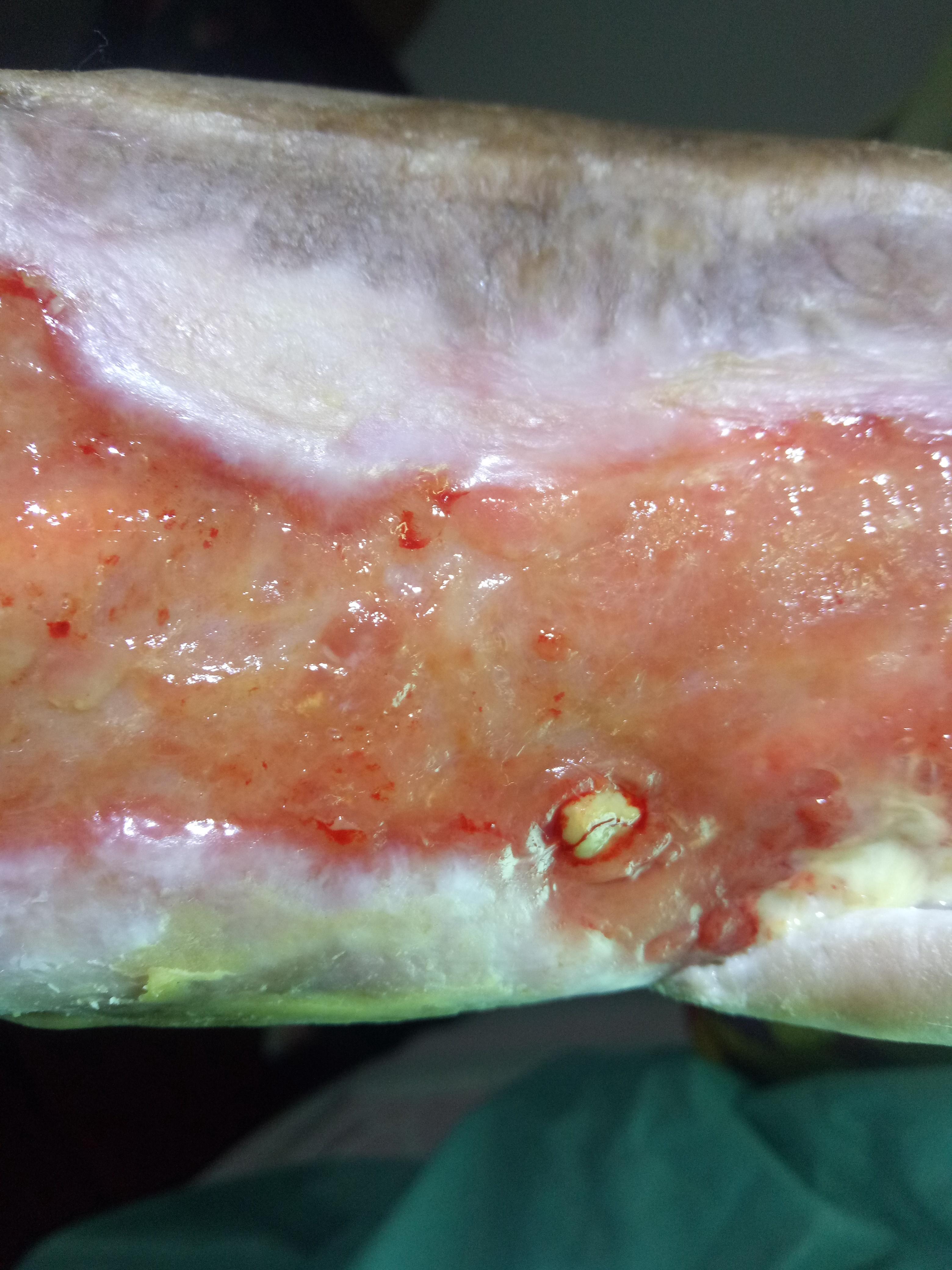 纯中医治疗糖尿病烂脚七个月的图片