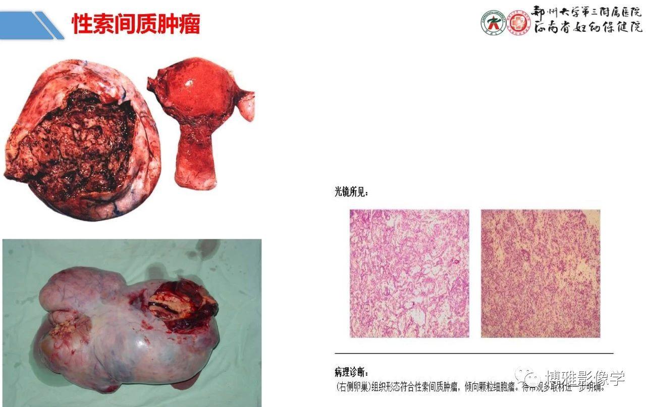 不同類型卵巢腫瘤的病理變化是什麼,卵巢腫瘤的影像診斷思路,第3張