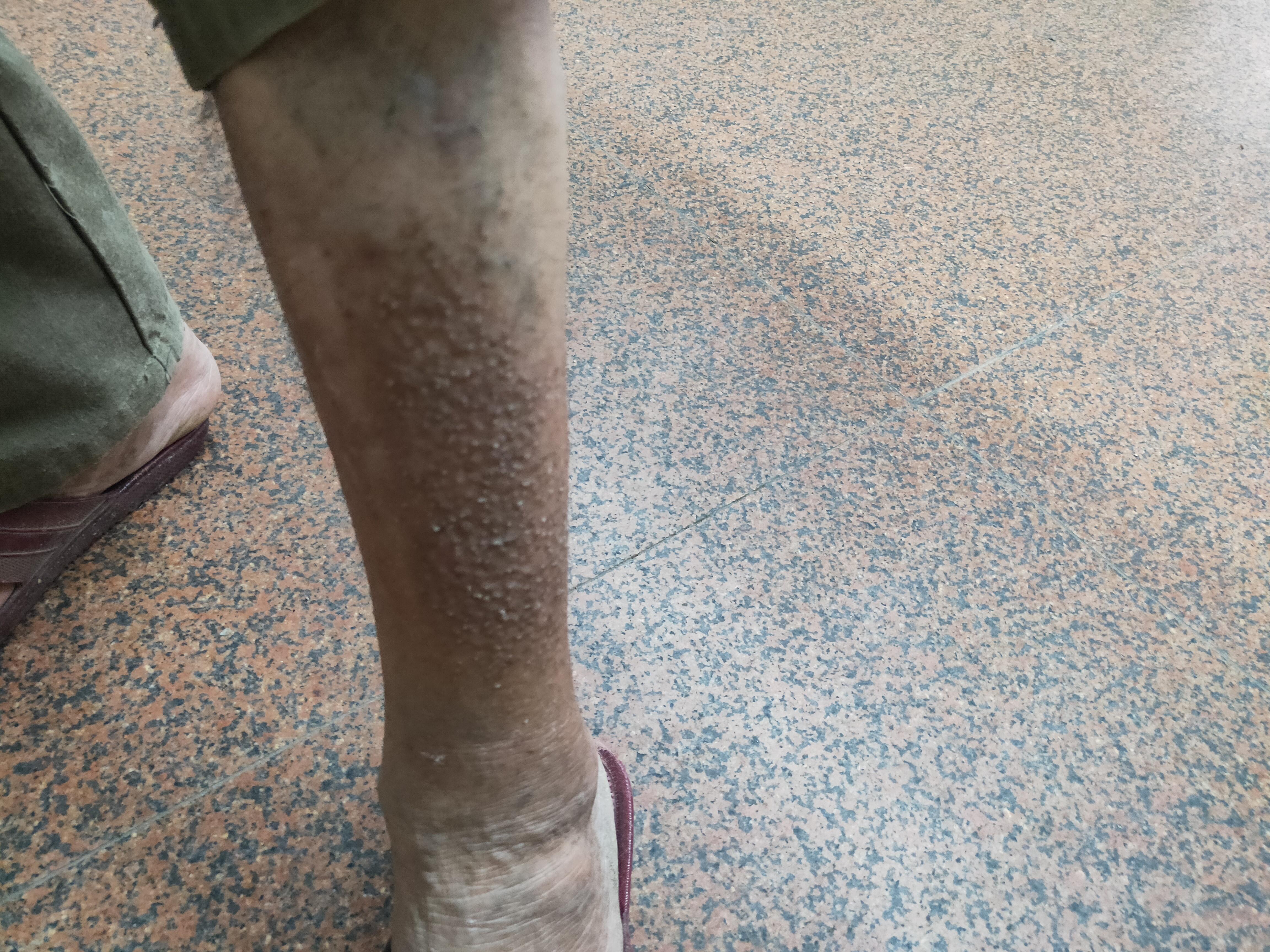 小腿上长很多一粒一粒,这是什么病?