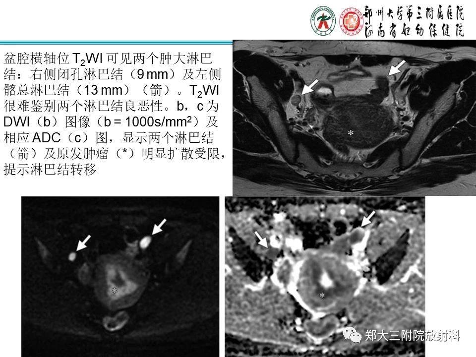 如何判斷盆腔腫瘤惡性淋巴結的轉移