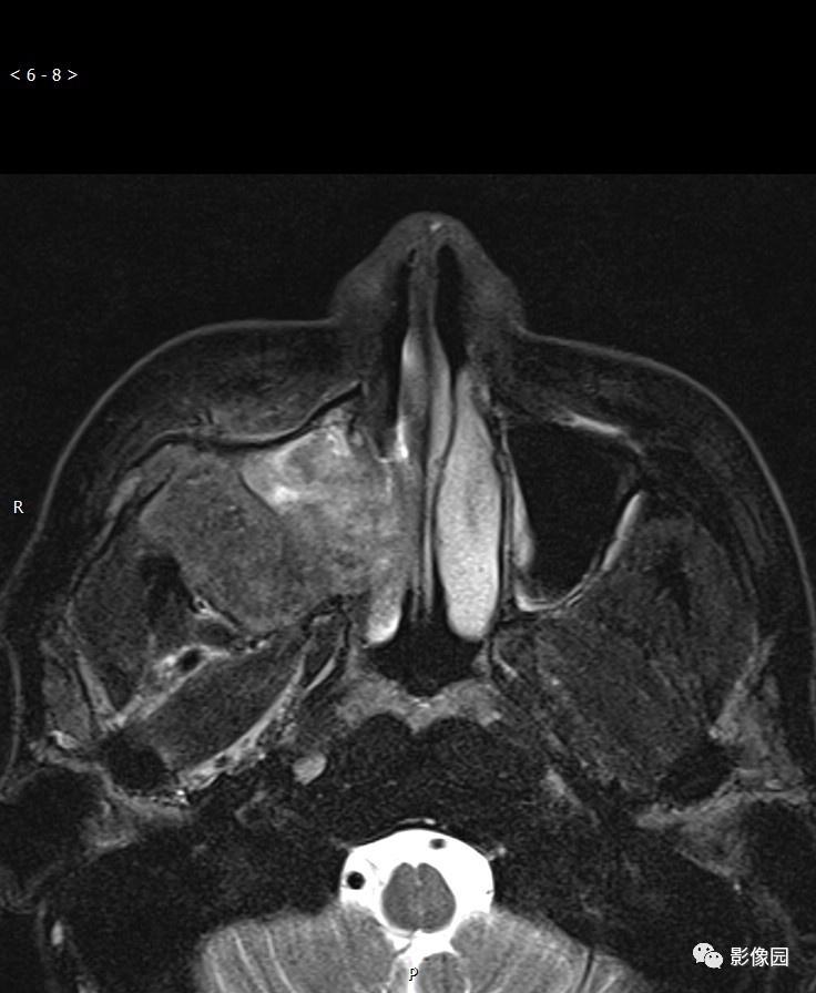 专业资源典型右侧上颌窦癌