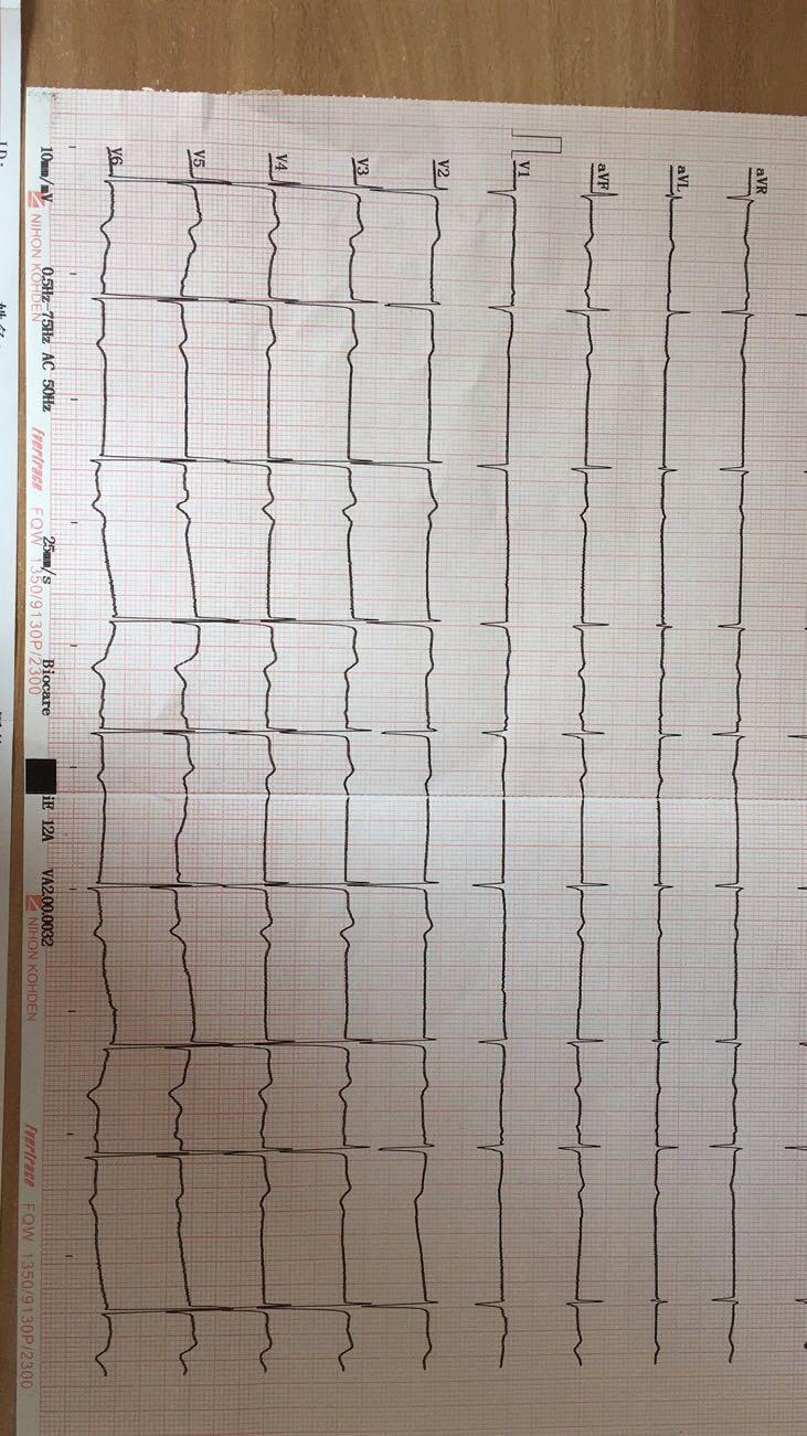 哪位老師幫忙看看心電圖