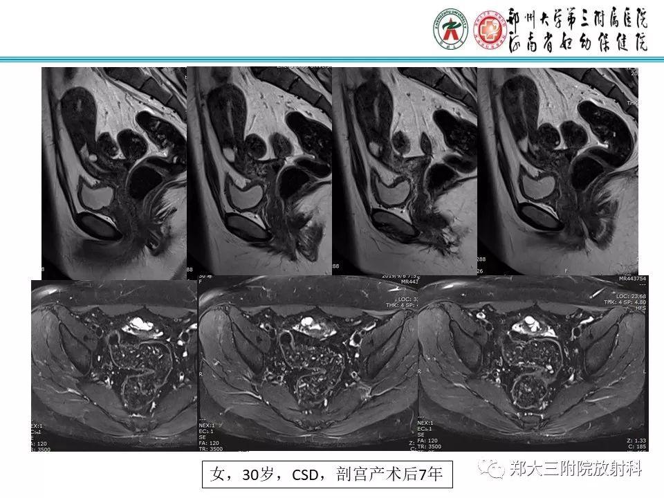 子宫切口憩室的影像学表现