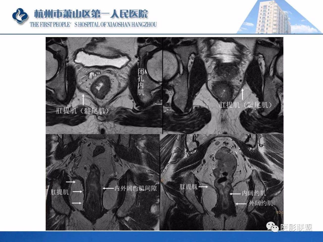 专业资源肛瘘的mri诊断